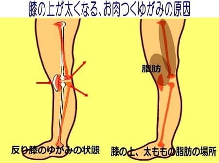 中目黒整体レメディオ 院長　渡邉潤一さんのインスタグラム写真 - (中目黒整体レメディオ 院長　渡邉潤一Instagram)「膝の上にお肉が付いてしまうのは、下記に挙げる３つのプロセスでおこります。  １：膝のゆがみである反り膝により、太ももの骨の位置、さらに膝下の骨がゆがみます。それにより膝関節に詰まりが生じる  ２：太もも前側にある筋肉（大腿四頭筋）が緊張した事で、膝部分の皮膚との間にも隙間が生まれる  ３：その隙間に、むくみが溜まり、さらにむくみが脂肪を引き寄せふくらむ  膝の上にお肉がついている方は、腰が反っていて（反り腰）、骨盤が前側に傾いています（反り腰の骨盤）。 さらに膝関節が後ろへと弓なりにゆがんでいます（反り膝）  骨盤のゆがみから膝関節が弓なりにゆがみ、太ももの筋肉を緊張させたことで、膝の皮膚との間に隙間が生まれます。  これが俗にいう皮膚の「たるみ」です。  また、筋肉が硬くなり弱くなったことで、皮膚を引き寄せられない状態なり、その皮膚がたるんだ部分にむくみが入り込む事でたるみを大きくふくらませます。  これが骨のゆがみが引き起こす、膝の上にお肉がついてしまう原因です。 . . . それでは、ストレッチをご紹介します。  ストレッチ手順： ①正座で座り、後に倒れる。 両膝が離れないように、床からあまり浮かないように。 また両膝が離れないように気をつける。  ②身体が硬い方は、首から背中・腰にかけてタオルやクッションを敷き、上半身を安定させてください。  回数：一日３～５回 ３０秒～１分  注：腹式呼吸で行ない、呼吸を止めない。腰が痛いときは避ける。  初めは前ももの半分より下(膝側)が伸ばされ、柔らかくなるにつれて前もも全体が伸びるようになってきます。 . . この他の反り膝のゆがみによる影響について、ストレッチ方法については、 プロフィールのブログURLから ↓ テーマ別 ↓ ・反り膝 原因 矯正方法 治し方 ・パーツ別矯正ストレッチ を、ご覧ください。 . . . 💮施術のご案内 中目黒整体レメディオ：骨盤・美脚コース ご予約はHPの予約フォームか、お電話（0357735977）にてご連絡ください。  HPへのリンクは、プロフィール欄の【HP・予約】、またはブログ記事下にあります。 . . . #大転子 #大転子矯正 #o脚矯正 #x脚矯正 #膝下o脚 #XO脚 #骨格矯正 #骨盤矯正 #産後骨盤矯正 #下半身太り #下半身痩せ #太もも痩せ #ふくらはぎ痩せ #反り膝  #反り腰 #骨盤の歪み #整体 #中目黒 #レメディオ #姿勢矯正 #中目黒整体レメディオ #整体サロン」2月22日 18時23分 - remedio_watanabe