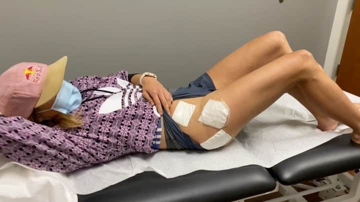 のインスタグラム：「It’s hard to feel so out of shape, so not like an athlete, and so much like there’s not much I can do about it. But the mental side is what I can control in these next days— so I’ll begin again there! - The surgery I had Friday was to remove the 6 screws that I had previously holding my pelvic bone together after the breaks on each side. The surgery went relatively smoothly, except for a complication with bone growth over one of the screws, which led to some hammering, vice grips, and a stripped screw that needed to be plied out. My surgical team is f**ng bada** though, and I’m so thankful for everyone on it. The bone growth was in long term a good sign— healthy bones and good nutrition 😚. - That said, this weekend I felt pretty down and out.  Every surgery comes with its post surgery Lull I suppose... and while this operation was relatively simple, it still involved cutting back open by my lower abs and opening back the adhesions. - I guess the end is near and that’s my driving light. But it has been hard emotionally to be back to what feels like square 1 when it comes to movement and needed rest, AND another break from climbing as the holes in my hips fill with bone and become sturdy again.  - Honestly, all I want to do is be back to a fully operational GO- lifestyle ... to be able to walk down the street without this cloud of fear of slipping on ice and messing up my pelvis... to get back to lead climbing like I had pre 5th surgery... - The last 9 months have included 5 surgeries... 5 humbling, rock bottom, broken to my foundation phases. And now I am excited to actually rebuild. 🦾 so. It’s hard to find patience now. But I know it’s the last of it 🙏🏼」
