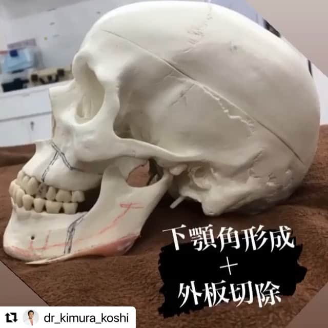 東京美容外科公式のインスタグラム：「顎からエラまで綺麗な1本の骨片で切除出来るのは確かな技術と経験がある執刀医だけです☺️東京美容外科は熟練の常勤麻酔科医が待機している美容クリニックです。  . . . 📞お問い合わせはこちら💁🏼‍♀️ 詳しくはプロフィールのURLから公式サイトへ. ▼フリーダイヤル 0120-658-958 （コールセンター受付時間：9：00～21：00） ▼LINE予約 @ tkc110 ========================= #東京美容外科#美容整形#整形#美活#美容#美容外科#特別外来#他院修正#鼻#豊胸#骨切り#輪郭形成#名古屋#赤坂」