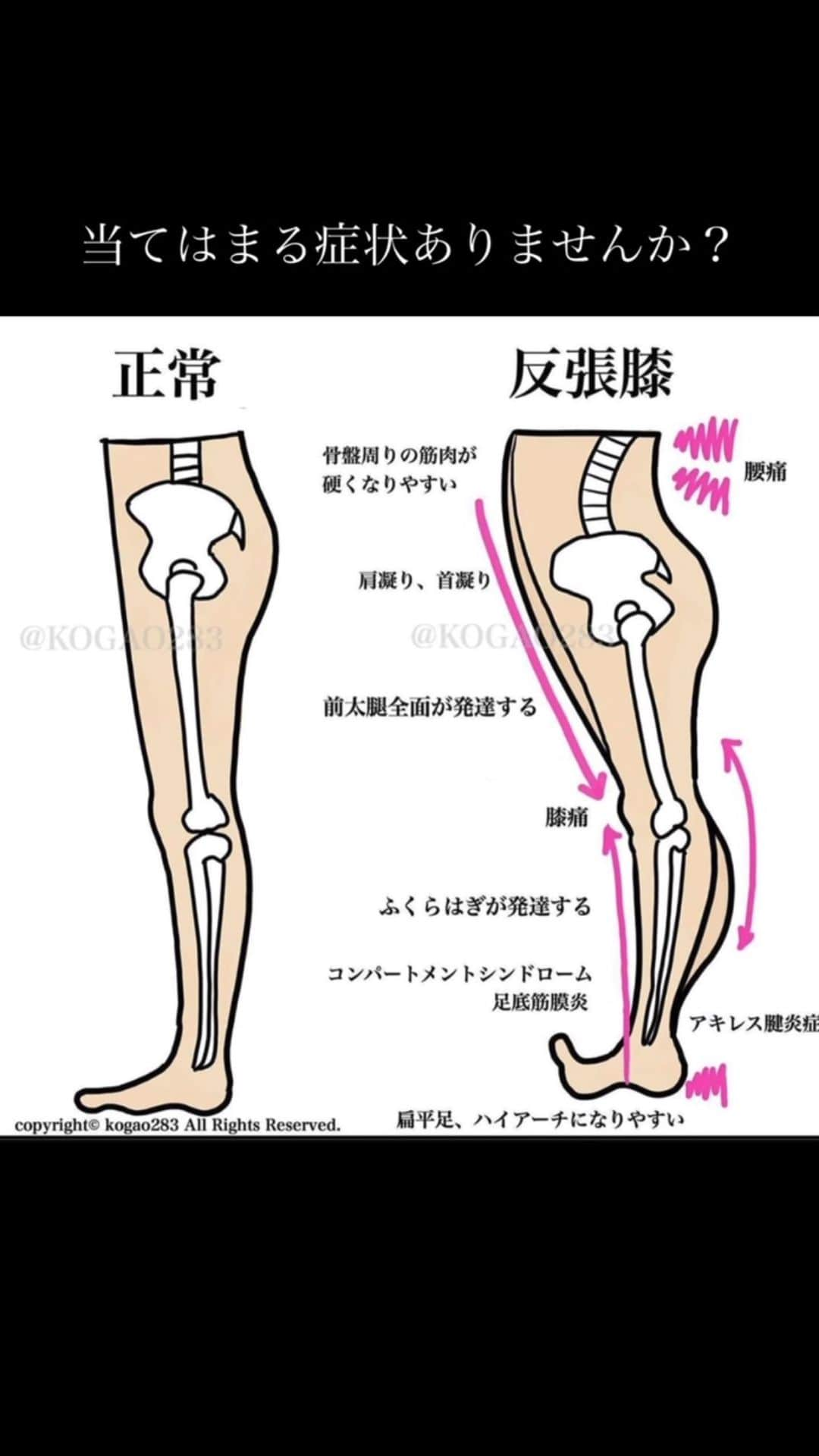 kogao283のインスタグラム：「腰痛 反張膝  #太ももストレッチだそう  大腿四頭筋は太ももの前面にある筋肉で、ひざを伸ばす膝関節の伸展動作と太ももを前に挙げる（股関節の屈曲）動作、骨盤を立てる（骨盤の前傾）動作の際に働いています。  この筋肉が硬くなると、ひざを深く曲げられなくなったり、太ももを体幹の後ろに伸ばす（股関節の伸展）動作の関節可動域が小さくなってしまいます。 筋力が弱くなると、太ももを前に高く挙げられなくなったり、ひざを真っ直ぐに伸ばす動作が困難となります。  もも前の筋肉の張り、凝りを緩和したい人、膝を曲げる動作を柔らかくしたいにオススメのストレッチです。」