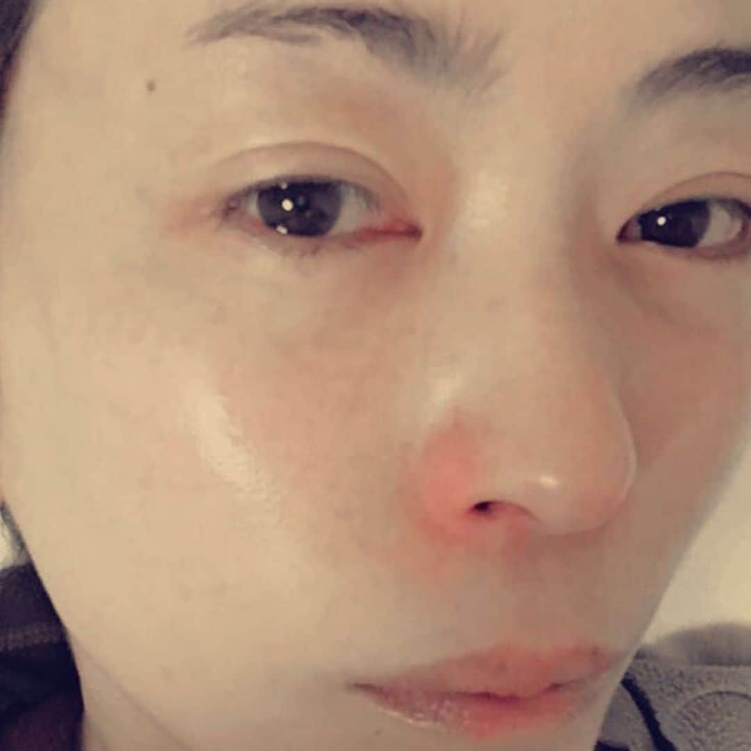 小林香織さんのインスタグラム写真 - (小林香織Instagram)「鼻真っ赤。 目しょぼしょぼ。 一日一回の薬っていつ飲むのが効くの……？ ・ ・ つか、久々に自分の顔。もはや、二枚目の方が自分のキャラ……。 ・ ・ 一日を通して鼻をかんでいた。 ・ ・   #花粉症 #hayfever #重症  #薬効かない」2月24日 22時28分 - kaorindrums
