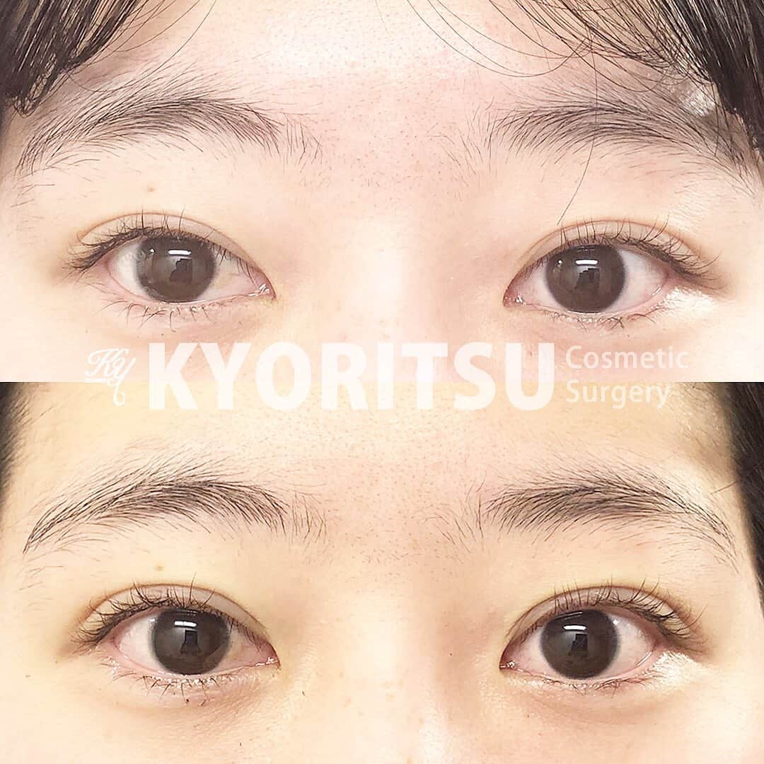 共立美容外科・歯科・皮膚科のインスタグラム：「ラインをはっきりさせる二重術🙋🏼‍♀️💓  📸﻿ 上:施術前﻿ 下:施術直後 ﻿ 👩🏻‍⚕️担当医: 副総括院長　遠山先生﻿ ﻿ 💉施術内容:P-PL挙筋法  😷DT:腫れ・内出血 ﻿ ⚠️リスク:腫れ・内出血・左右差・キズあとなど﻿ ﻿ ﻿ ⚠︎ご予約の際は﻿ 『公式インスタを見た』﻿ とお伝えいただけますと幸いです😊✨﻿ ﻿ 施術モニター様も募集中です﻿ ﻿ ﻿ 📍共立美容外科・歯科　新宿本院﻿ 0120-500-340﻿ 東京都渋谷区代々木2-9-2 久保ビル7Ｆ﻿ 診療時間﻿ 10:00〜19:00﻿ ﻿ ﻿ #共立美容外科 #美容整形前後 #糸リフト #プチ整形しました #整形したい #プチ整形 #韓国整形  #美容外科医 #二重整形 #성형외과 #성형전후 #모델 #맞팔하면선팔 #맞팔환영 #시술후기 #整形前後 #美容整形情報 #モニター募集 #相互フォロー #キャバクラ #ホスト #二重になりたい」