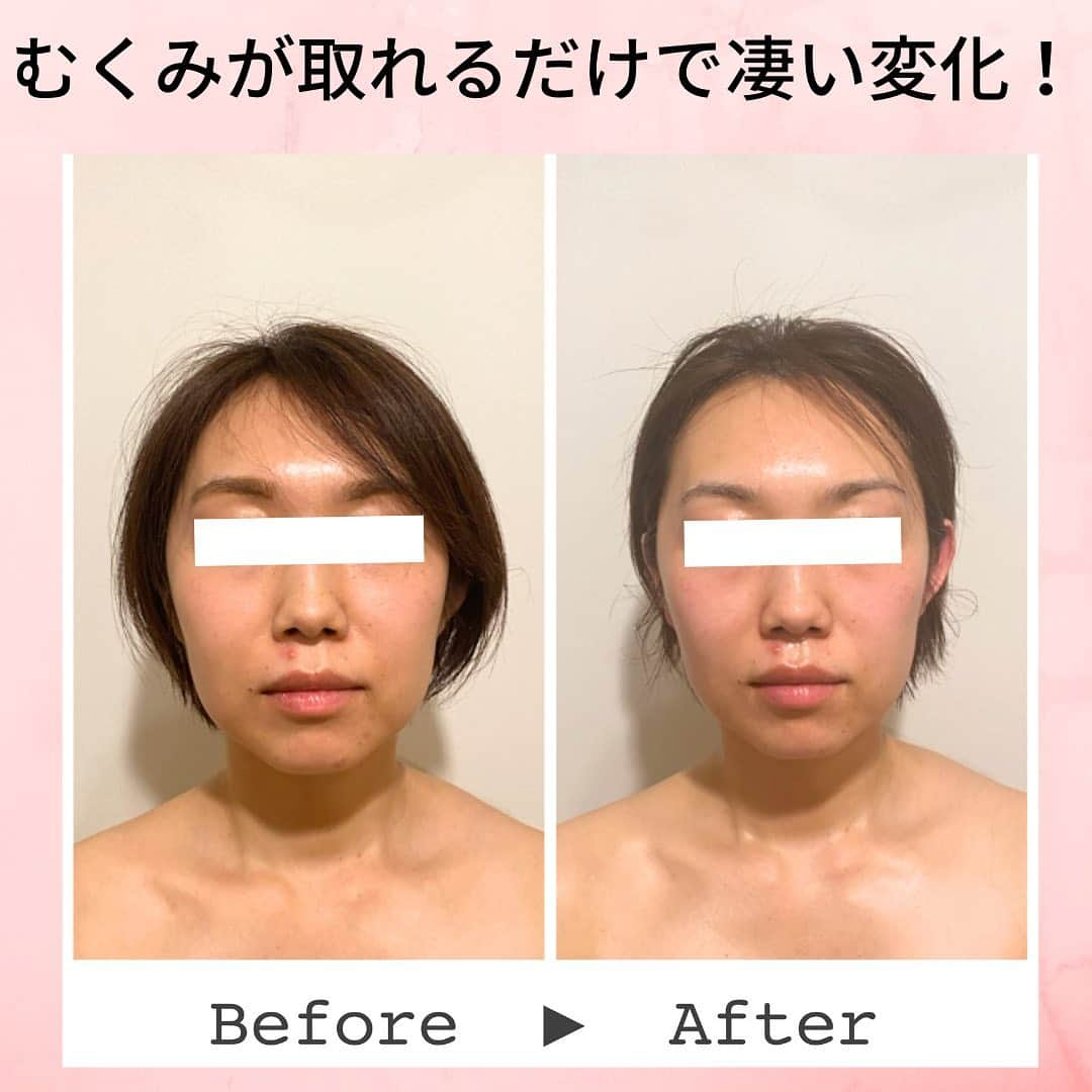 Eternal Total Beauty Salonのインスタグラム：「【ビフォーアフター】  老廃物って恐ろしい🥺😱  私が行っている施術は 骨格、脂肪、筋肉、リンパ、脳脊髄液にアプローチしていますが  こちらのお客様は元々骨格も小さかったので老廃物が溜まっていた事により全体的に大きさが増していました😳  本来のお顔が出現した事で、より 細かな骨格の微調整が出来ます✨✨  実際にお会いしていて最初のご来店より-5歳は若くなった印象があります❣️  これからさらにバランスの整ったキレイなお顔に仕上げていきますね💕  ＊＊＊＊＊＊＊＊＊＊＊＊＊＊  恵比寿駅西口徒歩4分♪ インディバエステ/小顔・痩身  営業時間　11:00〜21:00(19:00最終受付)  定休日　不定休  Tel 0364163830 お電話はつながり難い事が多いのでDMもしくはトップページの予約サイトから🙇‍♀️ 【@beautylian.111】  ＊＊＊＊＊＊＊＊＊＊＊＊＊＊  #インディバ  #インディバエステ  #インディバサロン  #インディバ 東京 #小顔東京 #小顔 #コルギ  #小顔矯正 #ビフォーアフター #ビフォーアフター写真  #セルライト除去  #免疫力を高める  #結果の出るサロン　 #顔の幅が狭くなる  #えらはり改善  #エラ張り解消  #左右差が整います  #むくみ防止  #浮腫み解消  #顔痩せ効果  #冷え性改善  #体質改善 #高周波 #美と健康 #リフトアップ #エニシーグローパック正規取扱店」