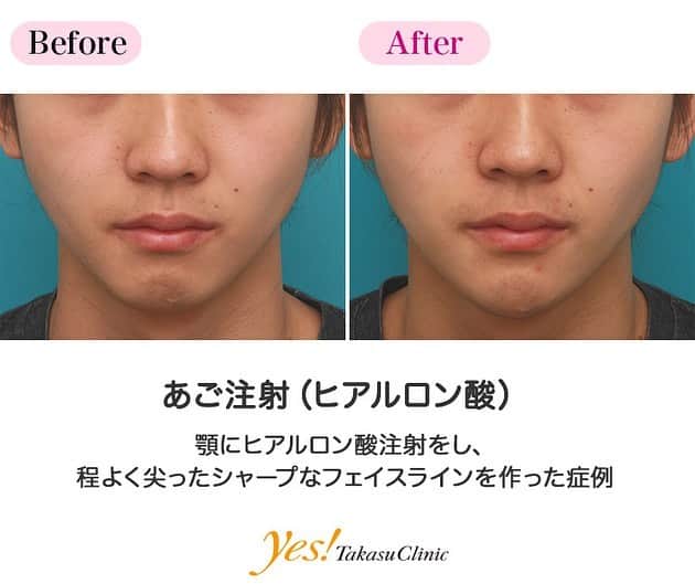 高須クリニックのインスタグラム：「👨🏻‍⚕️高須幹弥医師からのコメント✨⠀ 20代男性の患者様で、顎先を出してシャープに尖らせたいというご要望でした。 診察させていただいたところ、顎先の形が平坦で、やや引っ込んでいました。 シリコンプロテーゼを入れても良いのですが、少し出すだけでも、綺麗に顎先が尖ってバランスが良くなりそうだったので、ヒアルロン酸注射をすることになりました。 顎専用のヒアルロン酸を1本（1cc）顎先に注入して、顎先が斜め下方向に出るようにしました。 注射後は、程よく顎先が出て、シャープなフェイスラインになり、バランスが良くなりました。 また、平坦で四角っぽかった顎先が自然に尖りました。 ---------------------------------------------------- 🌈料金✨⠀ ●あご注射（ヒアルロン酸） ヒアルロン酸 ¥50,000 / 長期持続型ヒアルロン酸注射シャープラインジョウ ¥150,000【全院】 ---------------------------------------------------- ⚠️リスク・副作用・合併症✨⠀ ●あご注射（ヒアルロン酸） 内出血（注射針が血管に当たってしまった場合） 仕上がりのわずかな左右差（完璧なシンメトリーは不可） 仕上がりが完璧に自分の理想の形にならないことがある アレルギーが生じる可能性 注入後の感染 過度にいじったり揉んだりすると腫れる可能性 --------------------------------------------------- 😊施術についての詳細✨⠀⠀ https://www.takasu.co.jp/photo/agochu36.html ---------------------------------------------------- 📞ご予約・お問い合わせ✨⠀ 0120-5587-10⠀ https://www.takasu.co.jp/cgi-bin/form/contact.cgi ※症例写真や施術に関するご質問なども上記までお願い致します。 ---------------------------------------------------- #あご注射 #ヒアルロン酸注射 #顎先を出したい #シャープなフェイスライン  #皮膚 #美容 #美肌 #エイジングケア #美容整形 #美容外科 #美容クリニック #美容好き #美容皮膚科 #モニター #モニター募集 #高須クリニック #高須クリニック名古屋 #高須幹弥 #整形したい #プチ整形 #症例 #症例写真 #可愛くなりたい #可愛い #美人」