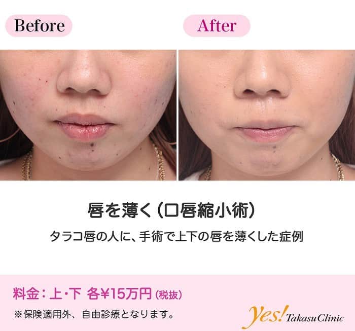 高須クリニックのインスタグラム：「👨🏻‍⚕️高須幹弥医師からのコメント✨⠀ 20代男性の患者様で、顎先を出してシャープに尖らせたいというご要望でした。 診察させていただいたところ、顎先の形が平坦で、やや引っ込んでいました。 シリコンプロテーゼを入れても良いのですが、少し出すだけでも、綺麗に顎先が尖ってバランスが良くなりそうだったので、ヒアルロン酸注射をすることになりました。 顎専用のヒアルロン酸を1本（1cc）顎先に注入して、顎先が斜め下方向に出るようにしました。 注射後は、程よく顎先が出て、シャープなフェイスラインになり、バランスが良くなりました。 また、平坦で四角っぽかった顎先が自然に尖りました。 ---------------------------------------------------- 🌈料金✨⠀ ●あご注射（ヒアルロン酸） ヒアルロン酸 ¥50,000 / 長期持続型ヒアルロン酸注射シャープラインジョウ ¥150,000【全院】 ---------------------------------------------------- ⚠️リスク・副作用・合併症✨⠀ ●あご注射（ヒアルロン酸） 内出血（注射針が血管に当たってしまった場合） 仕上がりのわずかな左右差（完璧なシンメトリーは不可） 仕上がりが完璧に自分の理想の形にならないことがある アレルギーが生じる可能性 注入後の感染 過度にいじったり揉んだりすると腫れる可能性 --------------------------------------------------- 😊施術についての詳細✨⠀⠀ https://www.takasu.co.jp/photo/agochu36.html ---------------------------------------------------- 📞ご予約・お問い合わせ✨⠀ 0120-5587-10⠀ https://www.takasu.co.jp/cgi-bin/form/contact.cgi ※症例写真や施術に関するご質問なども上記までお願い致します。 ---------------------------------------------------- #あご注射 #ヒアルロン酸注射 #顎先を出したい #シャープなフェイスライン  #皮膚 #美容 #美肌 #エイジングケア #美容整形 #美容外科 #美容クリニック #美容好き #美容皮膚科 #モニター #モニター募集 #高須クリニック #高須クリニック名古屋 #高須幹弥 #整形したい #プチ整形 #症例 #症例写真 #可愛くなりたい #可愛い #美人」