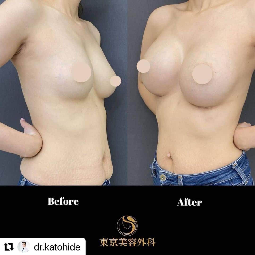 東京美容外科公式のインスタグラム：「仙台院院長加藤先生の豊胸症例です🥰✨ #Repost @dr.katohide with @make_repost ・・・ こんにちは。 東京美容外科　加藤です。  今回ご紹介するのは【乳房増大術（シリコンバッグによる豊胸術）】です。  豊胸手術で用いるバッグのサイズは様々です。大きなサイズを希望されても皮膚の厚さ、乳腺の大きさ、体格によって制限される事もあります。 場合によっては2回に分けて行なうこともあります。  また、挿入位置も腋窩や乳房下溝線などがあります。腋窩からのアプローチは傷は見えにくいですがサイズによってはお断りさせて頂く場合もあります。  今回は乳房下溝線からのアプローチによる豊胸手術を行いました。以前に他院でシリコンバッグによる豊胸術をされたとのことでしたがもっと大きくしたいとの御希望でご来院下さいました。 以前のバッグを除去し新たに425ccのシリコンバッグを入れております。  シリコンバッグプロテーゼを挿入する豊胸術は、2カップ以上の大幅なサイズアップ、半永久的に形を持続、入れ替え可能で大きさや形を変更出来る等の、メリットがある豊胸術です。 また、お体の状態やご希望をふまえ、患者様一人ひとりに合わせてシリコンバッグプロテーゼの挿入位置を替え、より自然なバストに仕上げることが可能です。  お悩みの方は是非一度御来院下さい。  モニター募集中です お問い合わせは👇 https://bit.ly/2VF6wA3 ㅤㅤㅤㅤㅤㅤㅤㅤ 【東京美容外科】. ==🎁お問い合わせはこちら🎁====﻿. 詳しくはプロフィールのURLから公式サイトへ♪﻿ ▼フリーダイヤル ☎0120-658-958 （コールセンター受付時間：9：00～21：00） . ▼LINE予約 @ tkc110 ============================== #東京美容外科  #美容外科専門医  #形成外科専門医  #レーザー専門医  #頭蓋顎顔面外科学会専門医  #JSAPS  #アンチエイジング﻿ #instagram  ﻿ #モニター募集 #美容 #美容外科 #美容クリニック #整形 #美容好きと繋がりたい #美意識高め #豊胸 #爆乳   #乳房   #日帰り  #傷痕」