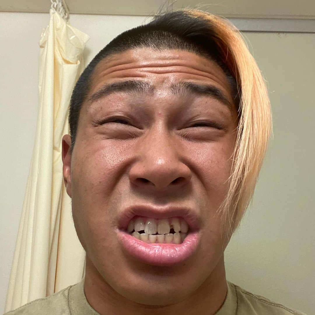 関札皓太のインスタグラム：「試合でも練習でもなくカチカチになったお米で欠けた前歯。 歯医者さんによって再び再生しましたのでご報告致します。」