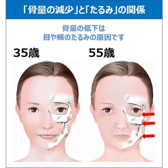 kogao283のインスタグラム：「骨密度の低下がシワやたるみの原因に!? ・ {骨の真実。1} ・ 頭蓋骨の老化がシワやたるみの原因に!? 頭蓋骨の骨粗しょう症が顔の印象を老けさせる。  鏡を見るたび気になり始めた、フェイスラインのたるみ、目尻や額のシワ。 ・ その原因は、主に加齢による肌の保湿力の低下、コラーゲンの減少といった「肌の老化」であることは知られていますが、実はこれ以外にも「頭蓋骨の老化」が大きく関係しているという。  頭蓋骨が痩せると、頭皮がたるんでフェイスラインがぼやけ、あごが痩せて口元のシワが増える、ほうれい線が濃くなる等の変化が現れます。 ・  顔の印象を老けさせるシワやたるみが、骨の劣化による骨粗しょう症が原因だったとは、今まで私たちが考えもしなかった事実です。 ・ しかも男性に比べて女性の方が何と約３倍も骨粗しょう症の患者数が多いというデータがあり、これを見逃すことはできません。 ・  骨芽細胞に刺激を与えるための運動として、「かかと落とし」と「ミニジャンプ」の2つ。 ・ 「かかと落とし」は、直立した姿勢でつま先立ちになり、 両脚のかかとを上げ下げする。 ・ 「ミニジャンプ」は、高さ10cmほどの台から両脚ですとんと降りて着地することを繰り返す。どちらも至ってシンプルな運動なので 気になる方は ぜひ毎日チャレンジしてみてくださいね。 ・ #骨粗鬆症#ダイエット#アンチエイジング#小顔ヘア#ブライダルヘアメイク #ブライダル前撮り #ブライダルネイル #美容整形#ヨガ#ストレッチ#ジム#リンパマッサージ#スキンケア#ヘアアレンジ#スキンケア#ブライダルエステ#マツエク#カットモデル#体質改善#小顔整形#小顔矯正#温活#妊活アカウント#東京小顔#東京サロン」