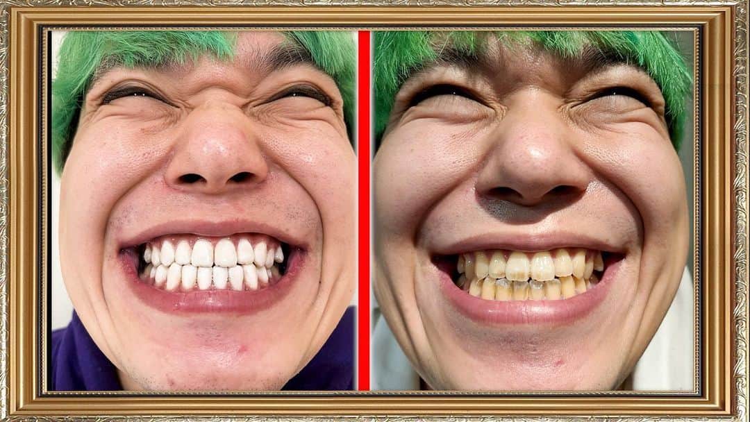 相馬トランジスタのインスタグラム：「31歳にして初めて歯が白くなりました  #歯が黄色い体質 #湧き出る清潔感 #モデルさんと繋がりたい」