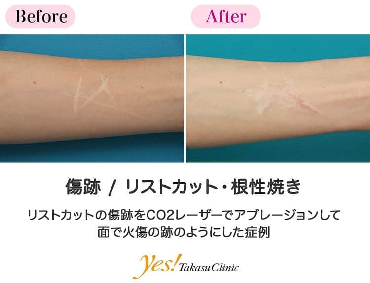 高須クリニックさんのインスタグラム写真 - (高須クリニックInstagram)「👨🏻‍⚕️高須幹弥医師からのコメント✨⠀ 20代女性の患者様で、前腕のリストカットの傷跡を消したいという御要望でした。 一度つけてしまったリストカットの傷跡を完全に消して元通りの綺麗な皮膚に戻すことはできません。 リストカットの傷跡の治療は、切除縫縮して1本の傷跡にするか、CO2レーザーアブレージョンで火傷の跡のようにするかどちらかです。 通常は切除縫縮して1本の傷跡にするほうが目立たない傷跡になるのですが、このリストカットの傷跡は傷の範囲が広く、切除縫縮することができないため、CO2レーザーアブレージョンをすることになりました。 術後は面で火傷の跡のようになり、リストカットの傷跡には見えなくなりました。 ---------------------------------------------------- 🌈料金✨⠀ ●リストカット・根性焼き（切除縫縮） 顔面の傷跡を単純に縫合する場合の目安　1cm ¥50,000 / 顔面以外の傷跡を単純に縫合する場合の目安　1cm ¥25,000【東京、横浜、名古屋、大阪】 ※また、単純に直線で縫合するのではなく、複雑な手術になる場合は料金が割増になります。※根性焼きの切除縫縮は1個¥50,000～100,000が目安です。 ●リストカット・根性焼き（アブレーション） ハガキ大 ¥500,000【東京、横浜、名古屋、大阪】 ---------------------------------------------------- ⚠️リスク・副作用・合併症✨⠀ ●リストカット・根性焼き 手術後に処方する抗生剤や痛みどめによるアレルギー症状 傷跡が肥厚性瘢痕やケロイドになる可能性 --------------------------------------------------- 😊施術についての詳細✨⠀⠀ https://www.takasu.co.jp/photo/keisei29.html ---------------------------------------------------- 📞ご予約・お問い合わせ✨⠀ 0120-5587-10⠀ https://www.takasu.co.jp/cgi-bin/form/contact.cgi ※症例写真や施術に関するご質問なども上記までお願い致します。 ---------------------------------------------------- #傷跡  #リストカット #リストカットの傷跡 #CO2レーザー #アブレージョン #リストカットの傷跡を消したい #傷跡を目立たなくしたい  #皮膚 #美容 #美肌 #エイジングケア #美容整形 #美容外科 #美容クリニック #美容好き #美容皮膚科 #モニター #モニター募集 #高須クリニック #高須クリニック名古屋 #高須幹弥 #整形したい #プチ整形 #症例 #症例写真 #可愛くなりたい #可愛い #美人」3月11日 10時24分 - takasu_staff