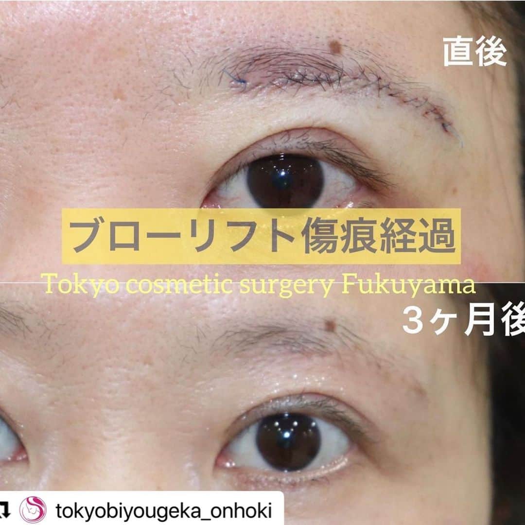 東京美容外科公式のインスタグラム：「#Repost @tokyobiyougeka_onhoki with @make_repost ・・・ 東京美容外科福山院です✨ 眉下切開法（ブローリフト）の 症例写真のご紹介です🤳  傷痕分かりますか？🤔  傷痕の綺麗さも大事ですが 皮膚の切除量も大事‼️  瞼のタルミを解消してスッキリとさせた印象へ✨  ブローリフト 術前 術直3ヶ月後  ⚠️リスク 内出血、腫れ、左右差 . webでのカウンセリングも実施中ですので お気軽にお問い合わせくださいね✨  . ご予約お待ちいたしております❤️ . 【東京美容外科】 ====□お問い合わせはこちら□===== ▼フリーダイヤル ☎0120-658-958 （コールセンター受付時間：9：00～21：00） . ▼LINE予約 @ tkc110 ============== #東京美容外科#福山#オルチャンリフト#ニキビ肌#汗管腫#綺麗#beautiful#二重#プチ#kawaii#コンプレックス#ハイフ#HIFU #アイプチ#卒業#キャンペーン#モデル#モニター#目力#美容#美意識#女子力#可愛い#美白ケア#唇#プルプル#ラシャスリップス #美容クリニック」