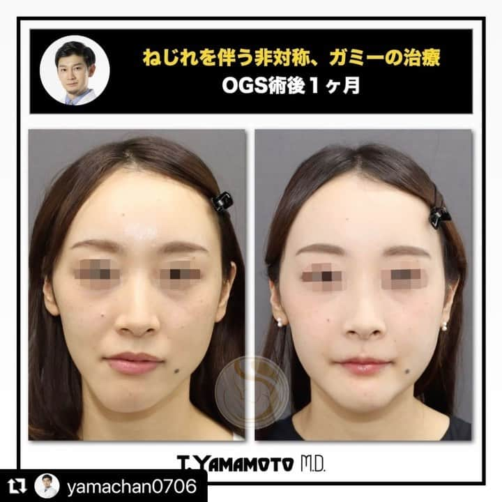 東京美容外科公式のインスタグラム：「骨切り山ちゃんの症例です。 輪郭形成はやはり激変しますね😤 術前カウンセリングから手術の日まで長い時間をかけてシミュレーションと準備を重ねて当日を迎えます。  東京美容外科は熟練のドクターと常勤麻酔科医が待機している本格派美容クリニックです。 . . . 📞お問い合わせはこちら💁🏼‍♀️ 詳しくはプロフィールのURLから公式サイトへ. ▼フリーダイヤル 0120-658-958 （コールセンター受付時間：9：00～21：00） ▼LINE予約 @ tkc110 ========================= #東京美容外科#美容整形#整形#美活#美容#美容外科#特別外来#他院修正#鼻#豊胸#オンライン#フェイスリフト#ハイフ#骨切り#輪郭形成#小顔#ogs#形成外科専門医」