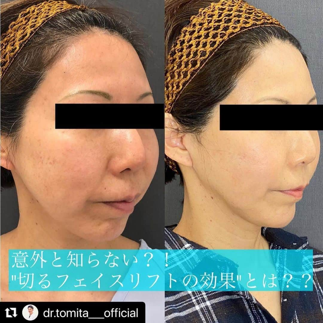 東京美容外科公式のインスタグラム：「銀座院院長冨田先生の症例です💁‍♀️ #Repost @dr.tomita___official with @make_repost ・・・ . 【切るフェイスリフト vs 糸リフト】 加齢によってできる皮膚のタルミ。 永遠のお悩みです。  HIFUや糸を使ったリフト治療もとても良い治療だと思いますが、治療には"適応"があります。  今回の症例の方は、以前からスレッドリフトを入れておられたとのことですが、効果を実感できなくなったとのことで、切るフェイスリフトをご希望されました。  左 : スレッドリフトを沢山されてきた手術直前  右 : 切るフェイスリフト術後1ヶ月 　　傷跡も残りにくいようにこだわってます  ここで、フェイスリフトですが、弛んだ皮膚を切るだけでは、リフト効果は約1〜2年程度だと言われております。顔の表情筋の上に存在する、SMAS(スマス)という膜を引き上げないと長期間の効果は出ません。  ※ 気になる方は、以前のfeedをご覧ください。  ただ、このフェイスリフトですが実は非常に難しい手術の部類に入ります。何故かというと、SMASという膜を剥がしていく中で、その周囲で顔面神経(顔の表情を作る運動神経です)が非常に複雑に絡み合っているので処理の仕方がとても煩雑だからです。  神経は素人目には一眼見ても、とても分かりにくく、山中でトリュフを探すようなイメージです。 切ってしまうと顔が動かなくなります、、、。  こうした背景から、HIFUや糸で簡単に引き上げる治療へとシフトした変遷があります。  ＊しっかりとSMASを引き上げてる動画も以前のフィードで載せております、本物の治療を提供してますよ。 (切る治療をしてるといって、実はSMASを剥がないで"弛んだ皮膚だけ"を処理してる治療院も少なくないかも知れません。)  お顔のタルミが気になる方はぜひご相談下さいませ。 . .  . .  . .  🌹当院が選ばれる理由 ✔︎豊富な症例数 ✔︎安心感のあるスタッフ、施術環境 ✔︎麻酔科専門医による安全麻酔 ✔︎丁寧なカウンセリング ✔︎形成外科専門医ならではの確かな技術🥼 ✔︎ナチュラルな仕上がり✨ ✔︎リピーターさん続出、ご紹介も多いです ✔︎大切なあなたの為に真剣に取り組みます  🏅東京美容外科ブランド🏅 それは修練を受けた医師だけが施術を認められる組織。 ピリッと背筋を伸ばして、治療にあたっております。 最善の結果を追及する気持ちが、より良い結界に繋がると信じてます。  💡あなたのお悩みに全力で対応します。 でも、どんな治療でもお引き受けする訳ではありません。ご希望の治療が、お客様に不利益であると判断した際にはお断りすることもあります。  ご予約/お問い合わせは ☎️ 0120-658-958  #冨田壮一 #東京美容外科銀座院 #東京美容外科 #形成外科専門医 #instagood #instagram #アンチエイジング #切るフェイスリフト #切るフェイスリフト名医  #ダーマペン #フェイスリフト #バッカルファット #眉下切開 #スレッドリフト #リファ #ヤーマン #facelift #smaslifting #day」