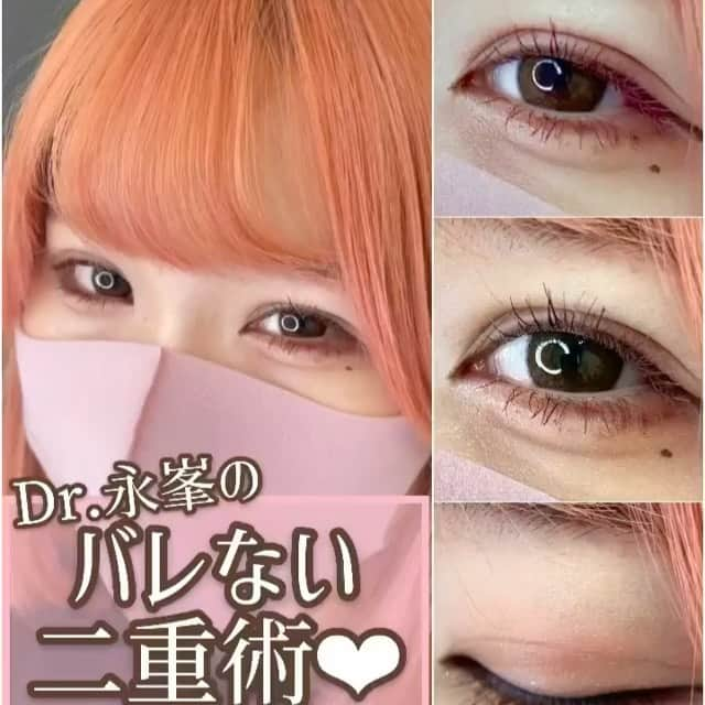 東京美容外科公式のインスタグラム：「東京美容外科　永峯先生の症例です💁‍♀️ #Repost @dr.nagamine with @make_repost ・・・ * ♡二重整形なら永峯祥子♡ 化粧映えするお目元はお任せください😋 * 〜糸玉傷跡なし✨直後からバレ辛い二重術〜 * ☑︎シークレットループダブル(二重埋没法) * まぶたの表面に傷を作らずに二重を形成します。施術直後から腫れが出ずらくお化粧も可能なので、ダウンタイムを極力抑えたい方におすすめの方法です！ * 写真 1枚目:施術2週間後 2枚目:施術前 * ☑︎リスク 腫れ、内出血、左右差、角膜損傷(稀)など * * 【♡全国からインスタ、YouTube指名殺到中😋♡】 【♡大手美容外科院長、技術指導医経験♡】 【♡女性ならではの美的センスと技術をお届けします♡】 * ———————————————————————— 🧡二重モニター様大募集中！🧡(モニター審査あり) また、目の下のクマ取り、鼻整形、小顔整形もモニター様も募集中です♡ DMでお問い合わせください♡ ———————————————————————— * * #東京美容外科 #二重整形 #二重整形なら永峯祥子  #二重埋没 #二重埋没法  #シークレットループダブル #美容整形 #美容外科  #アイプチ #アイメイク  #バレない二重術 #可愛くなりたい」