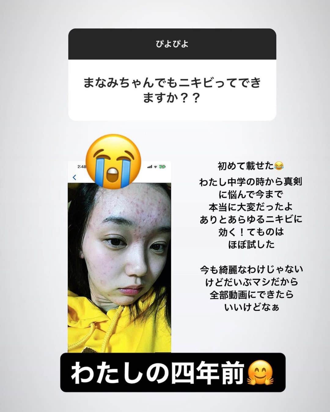 江野沢愛美さんのインスタグラム写真 - (江野沢愛美Instagram)「明るさ調節やフィルターなしを載せるのも恥ずかしいけど、😂 (夕日が綺麗で光が盛れた時の写真) (iPhone12proのカメラ綺麗やな)  だいぶ肌荒れで悩まなくなりました。 今もまだまだ完璧に綺麗なわけじゃ無いけど、肌荒れで悩んでた頃の(2018〜2020)の動画を撮りました♡ 肌が汚くてアプリで美肌モードマックスにしても隠せなかった肌の汚さ...🥲  ニキビ肌なので中学から毎度悩まされてるし、 これしたら絶対治るとかっていう決めつけの動画ではないけど、 良かった気がする事や使ったスキンケアを喋りました☺︎  毎回酷くなるとニキビの写真を撮っていたので、この写真たちが日の目を浴びる日がやっと来た、、、！笑 どんだけ可愛くなりたくてメイクしても洋服買っても 肌が荒れてるから自分には価値がないって思い込んでたなぁ。  公開は少し時間がかかる気もするけど YouTubeチャンネル登録をして首を長くしてお待ちください...🦒」4月7日 18時06分 - enosawa_manami