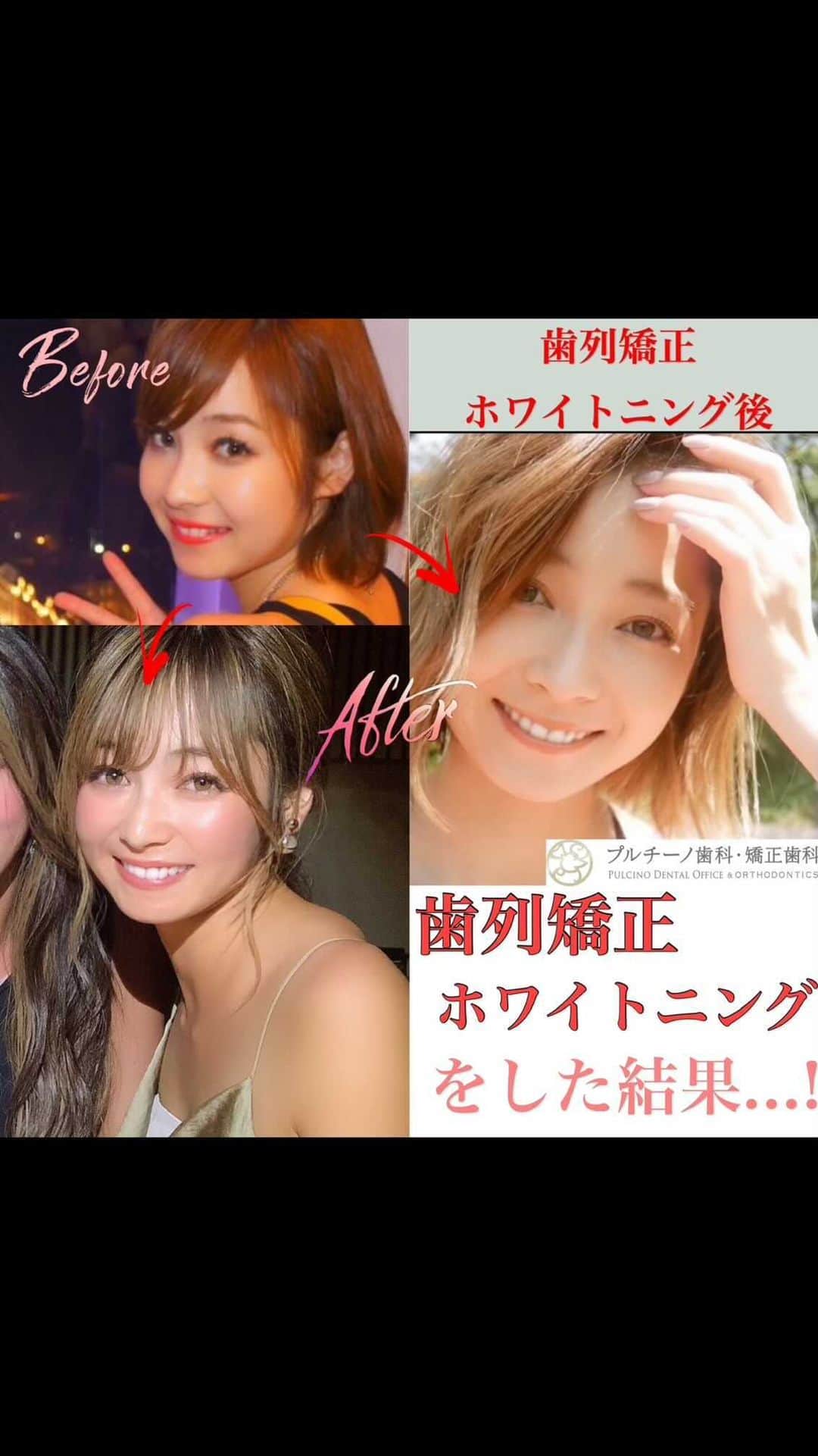 のインスタグラム：「【歯列矯正・ホワイトニングについて】  よくいただく質問🌸 私の15歳の頃から写真をまとめてみました✨ 歯が数本ガタついているのが気になって、2018年7月から始めた歯列矯正。インビザラインで整えながら、ホワイトニングもして歯をキレイにしてきました🦷🌸 歯並びを整えてほんっとうによかった🥺🙏 @pulcino_dental_office   まずメリットとしては ✔️清潔感が出て印象が180度変わる！ ✔️虫歯になりにくい ✔️自信が持てる ✔️噛み合わせがよくなる ✔️ホワイトニングで歯の強化、虫歯予防 ✔️ほうれい線がちょっと薄くなった！ (歯が横に広がったからかな？) ✔️顔の形も変わる  オトナの歯列矯正、ぜひ考えてみてください〜🌸 一生もので人生が変わるかもしれない、 いい自己投資だと思います🪴 私は名古屋の新瑞橋にある @pulcino_dental_office  で歯列矯正をしました！ とっても丁寧にカウンセリングをして下さって 院内の雰囲気もとても良くておすすめな歯医者さんです🦷 東京や四日市にもあるのでお近くの方はぜひカウンセリングだけでも行ってみてください🙇‍♀️ 今日はホワイトニングと歯のクリーニングも してもらいました✨🙏 過去の歯列矯正物語は　#natsumi_矯正物語　にまとめてるのでぜひチェックしてみて下さい🥰🙏  #歯医者#歯列矯正#歯#インビザライン#マウスピース矯正#マウスピース#歯並び#ホワイトニング#新瑞橋歯医者#名古屋歯医者#プルチーノ歯科#メイク動画#歯列矯正女子」