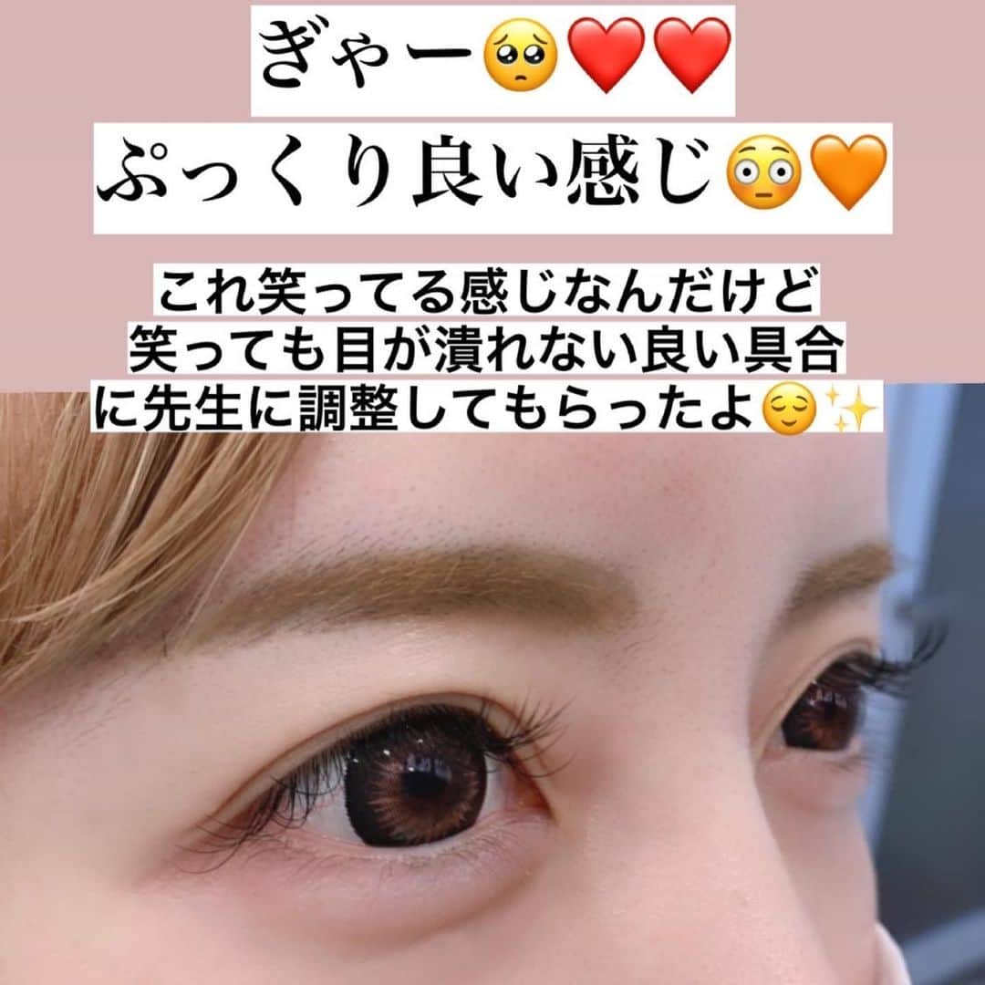 吉川ちえさんのインスタグラム写真 - (吉川ちえInstagram)「【プチ整形🧡涙袋ヒアルロン酸💉】 . 5年ぶりに涙袋ヒアルロン酸を注入しました🧏‍♀️💕 久しぶりにやったけど本当良かった~❤️やっぱり目が大きく見えるね🧚✨ . 今回ヒアルロン酸やったのは表参道にある Rejuva Medical Clinic🏥だよ🤲🧡 先生はレナ先生👧🏻💗 ( @drrena.a ) めちゃくちゃうまかった🥺❣️ . ヒアルロン酸はジュビダームのボルベラ使用✨ クリニックは1cc買い取りで 💰104500円(税込)🤍 . 1ヶ月以内ならリタッチ可能🧤 そして涙袋ヒアルロン酸で余ったヒアルロン酸は他の場所(例えば、顎やほうれい線、頬etc)に注入可能だよ⭐⭐ . 私は片目0.05ccしかうってないのw とにかく自然にしてもらった🧏‍♀️💕 笑った時に目が潰れない、不自然にならないデザインにしてもらったよ✨ . 痛みなんだけど麻酔テープ貼るし、 先生の腕が良くて全く痛くなかったよ🙋‍♀️💗 涙袋痛いって言う経験あるけど今回楽勝でした🐰🌼🌼🌼 . 涙袋ヒアルロン酸で先生のセンスが 出るから本当に腕ある先生を選ぶのがベスト‼️ . #rejuvamedicalclinic  #表参道レジュバメディカルクリニック  #涙袋ヒアルロン酸 #涙袋形成 #ヒアルロン酸 #ヒアルロン酸注入  #プチ整形 #ヒアルロン酸涙袋形成  #涙袋」4月17日 5時30分 - yoshikawachie_16