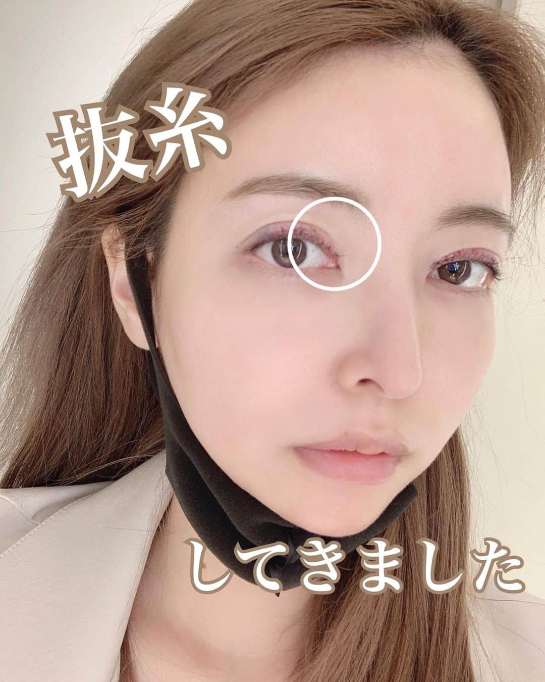 のインスタグラム：「睫毛上皮膚切除 ダウンタイム7日目！ 今日は抜糸をしたので 大きなダウンタイムは終わり🥺💓 . あっという間な一週間でした 睫毛上皮膚切除は ダウンタイムも少なく痛みもなく 楽勝でした☺️💕 . 一番痛かったのは今日やってきた 抜糸かなぁ やっぱり睫毛上だから めちゃくちゃ痛かったです🥲💓 . 経過はハイライトに 全部あるから参考までに… . #睫毛上皮膚切除#ダウンタイム#二重幅#二重幅修正#二重#整形#美容整形#ダウンタイム中 #ダウンタイム記録 #抜糸#抜糸完了」