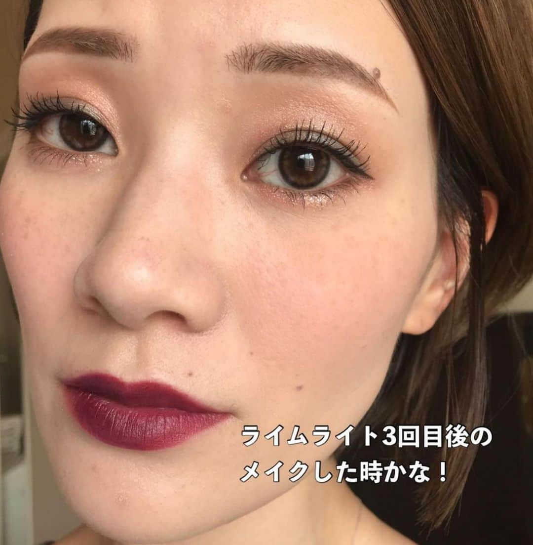 Arisaさんのインスタグラム写真 - (ArisaInstagram)「【DMとか質問BOXでシミ治療について多かったので前のやつを再投稿するね】  シミ治療してきてかれこれもう2年経つ。 たっかいデパコスの美白美容液とかクリームとかたくさん沢山使ってきたけど結局微々たる程度で、スキンケアにいくら投資したのかも分からない。 もうそれなら、美容皮膚科にお手伝いしてもらおうと思って通い出したのが幕張にある　@hadatoha 肌と歯のクリニック。 院長は余計なことは言わず、必要なものだけを勧め、必要なことしか言わない淡々とした院長wだけど、結果を見てもらえれば分かるはず。 腕がめちゃくちゃ良いんです。 千葉に住んでなくても遠方から来るお客様も多い。 正直ここまで綺麗にしてくれるとは考えてなかったし、莫大な金額がかかるとずっと思ってました。 （まぁ、それなりにかかってるけどスキンケア代金に比べたらね）  私は最初ライムライトコース（ピーリング→ライムライト→イオン導入　30,000円）をしばらくやっていて、6回目辺りからシミにはあまり反応しなくなってきたので、先生からこれ以上取りたいならレーザーだねと勧められましたが、金銭の関係で踏み込めず、2ヶ月に1回くらいライムライトコースを続けてました。  しかし、暫くしてどうせなら‼️ と思って【シミ半年治療プラン300,000円　モニター価格150,000円（顔出しだったかな？）】を契約しました。 （結果的に最初からこのコース組めばよかったと後悔、、、w）  このコースは半年間ライムライトコース6回分+シミ治療のレーザーは当て放題。なんてお得なんだ！と今は思えます。  ライムライトコースをしつつ、私は始めに【ピコレーザー（ピコスポットになるのかな？）】をやりました。 ライムライトでは反応しなかった薄いシミがめちゃくちゃ反応してくれて、これはYouTubeにも載せてます！ ※ただピコはダウンタイムが辛い！長い！ ピコはこの一度で、その後はダウンタイムがめちゃくちゃ少なく、より細かいシミに反応する【ルビーフラクショナル】を3度あてました！ これもYouTube載せてます！ これは史上最強に激痛なのですが、まあダウンタイムが少ないのなんの。 そして深いシミが取れる。 赤みとかにもとても効いてる気がする🤔  そしてやはりシミを取ると気になるのがホクロ。 どうせならと、炭酸ガスレーザーやQスイッチルビーレーザーなどで取りました！ 炭酸ガスだとしっかり取れるけど、赤みが引くまで半年程かかったなぁ。 この間はQスイッチルビーレーザーで取ったけど、赤みが少しあるくらいで炭酸ガスほどのダウンタイムはない！ ※Qスイッチだと2、3度やらないと完全には消えないです。 そんなこんなで久しぶりに美容皮膚科のレポートをしてみました！  スキンケアは変えずにトゥルーストナーとトゥルースドロップ、NANOAのクリーム使ってます☺️ ※ゼオスキンやエンビロンなどは一切使ってません。  質問コーナーとかでもお伝えしてますが、やはり化粧品でシミを取るのはコストがかかるし、100%取れるものではありません。 長い目を見て、シミと縁を切るのであれば是非私はレーザーに頼ることを勧めます。  私は、レーザーでシミ治療してスキンケアはシンプル‼️が一番好きです。  ここのクリニックにお願いして本当によかったと思えました。  ・ ・ #美容皮膚科#皮膚治療#シミ治療#ピコレーザー#ルビーレーザー#ピコフラクショナル#ルビーフラクショナル#肌と歯のクリニック#千葉美容皮膚科#ホクロ除去#ダウンタイム#ダウンタイム中#ダウンタイム記録#ダウンタイム経過#皮膚科通い」5月3日 18時47分 - saarariii