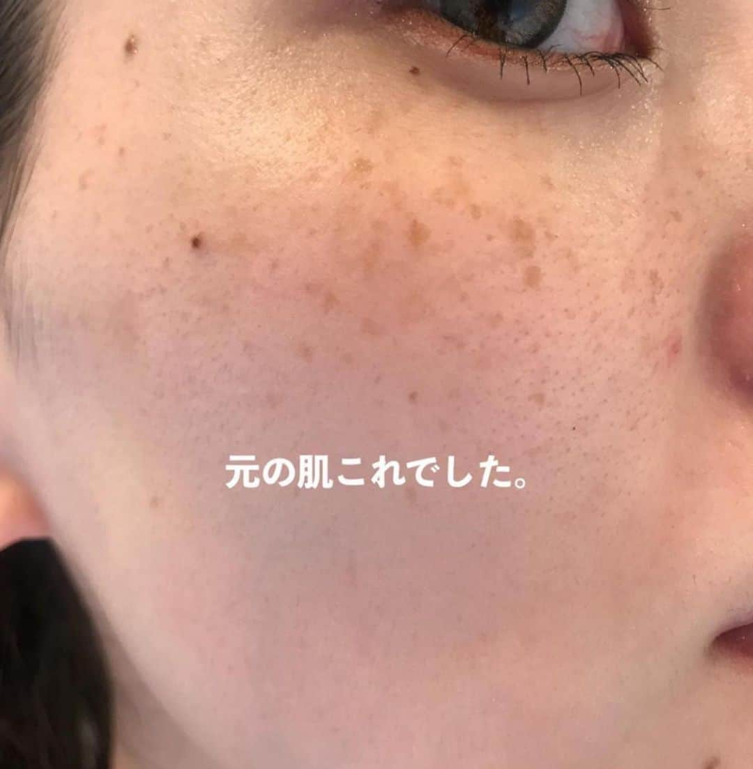 Arisaさんのインスタグラム写真 - (ArisaInstagram)「【DMとか質問BOXでシミ治療について多かったので前のやつを再投稿するね】  シミ治療してきてかれこれもう2年経つ。 たっかいデパコスの美白美容液とかクリームとかたくさん沢山使ってきたけど結局微々たる程度で、スキンケアにいくら投資したのかも分からない。 もうそれなら、美容皮膚科にお手伝いしてもらおうと思って通い出したのが幕張にある　@hadatoha 肌と歯のクリニック。 院長は余計なことは言わず、必要なものだけを勧め、必要なことしか言わない淡々とした院長wだけど、結果を見てもらえれば分かるはず。 腕がめちゃくちゃ良いんです。 千葉に住んでなくても遠方から来るお客様も多い。 正直ここまで綺麗にしてくれるとは考えてなかったし、莫大な金額がかかるとずっと思ってました。 （まぁ、それなりにかかってるけどスキンケア代金に比べたらね）  私は最初ライムライトコース（ピーリング→ライムライト→イオン導入　30,000円）をしばらくやっていて、6回目辺りからシミにはあまり反応しなくなってきたので、先生からこれ以上取りたいならレーザーだねと勧められましたが、金銭の関係で踏み込めず、2ヶ月に1回くらいライムライトコースを続けてました。  しかし、暫くしてどうせなら‼️ と思って【シミ半年治療プラン300,000円　モニター価格150,000円（顔出しだったかな？）】を契約しました。 （結果的に最初からこのコース組めばよかったと後悔、、、w）  このコースは半年間ライムライトコース6回分+シミ治療のレーザーは当て放題。なんてお得なんだ！と今は思えます。  ライムライトコースをしつつ、私は始めに【ピコレーザー（ピコスポットになるのかな？）】をやりました。 ライムライトでは反応しなかった薄いシミがめちゃくちゃ反応してくれて、これはYouTubeにも載せてます！ ※ただピコはダウンタイムが辛い！長い！ ピコはこの一度で、その後はダウンタイムがめちゃくちゃ少なく、より細かいシミに反応する【ルビーフラクショナル】を3度あてました！ これもYouTube載せてます！ これは史上最強に激痛なのですが、まあダウンタイムが少ないのなんの。 そして深いシミが取れる。 赤みとかにもとても効いてる気がする🤔  そしてやはりシミを取ると気になるのがホクロ。 どうせならと、炭酸ガスレーザーやQスイッチルビーレーザーなどで取りました！ 炭酸ガスだとしっかり取れるけど、赤みが引くまで半年程かかったなぁ。 この間はQスイッチルビーレーザーで取ったけど、赤みが少しあるくらいで炭酸ガスほどのダウンタイムはない！ ※Qスイッチだと2、3度やらないと完全には消えないです。 そんなこんなで久しぶりに美容皮膚科のレポートをしてみました！  スキンケアは変えずにトゥルーストナーとトゥルースドロップ、NANOAのクリーム使ってます☺️ ※ゼオスキンやエンビロンなどは一切使ってません。  質問コーナーとかでもお伝えしてますが、やはり化粧品でシミを取るのはコストがかかるし、100%取れるものではありません。 長い目を見て、シミと縁を切るのであれば是非私はレーザーに頼ることを勧めます。  私は、レーザーでシミ治療してスキンケアはシンプル‼️が一番好きです。  ここのクリニックにお願いして本当によかったと思えました。  ・ ・ #美容皮膚科#皮膚治療#シミ治療#ピコレーザー#ルビーレーザー#ピコフラクショナル#ルビーフラクショナル#肌と歯のクリニック#千葉美容皮膚科#ホクロ除去#ダウンタイム#ダウンタイム中#ダウンタイム記録#ダウンタイム経過#皮膚科通い」5月3日 18時47分 - saarariii