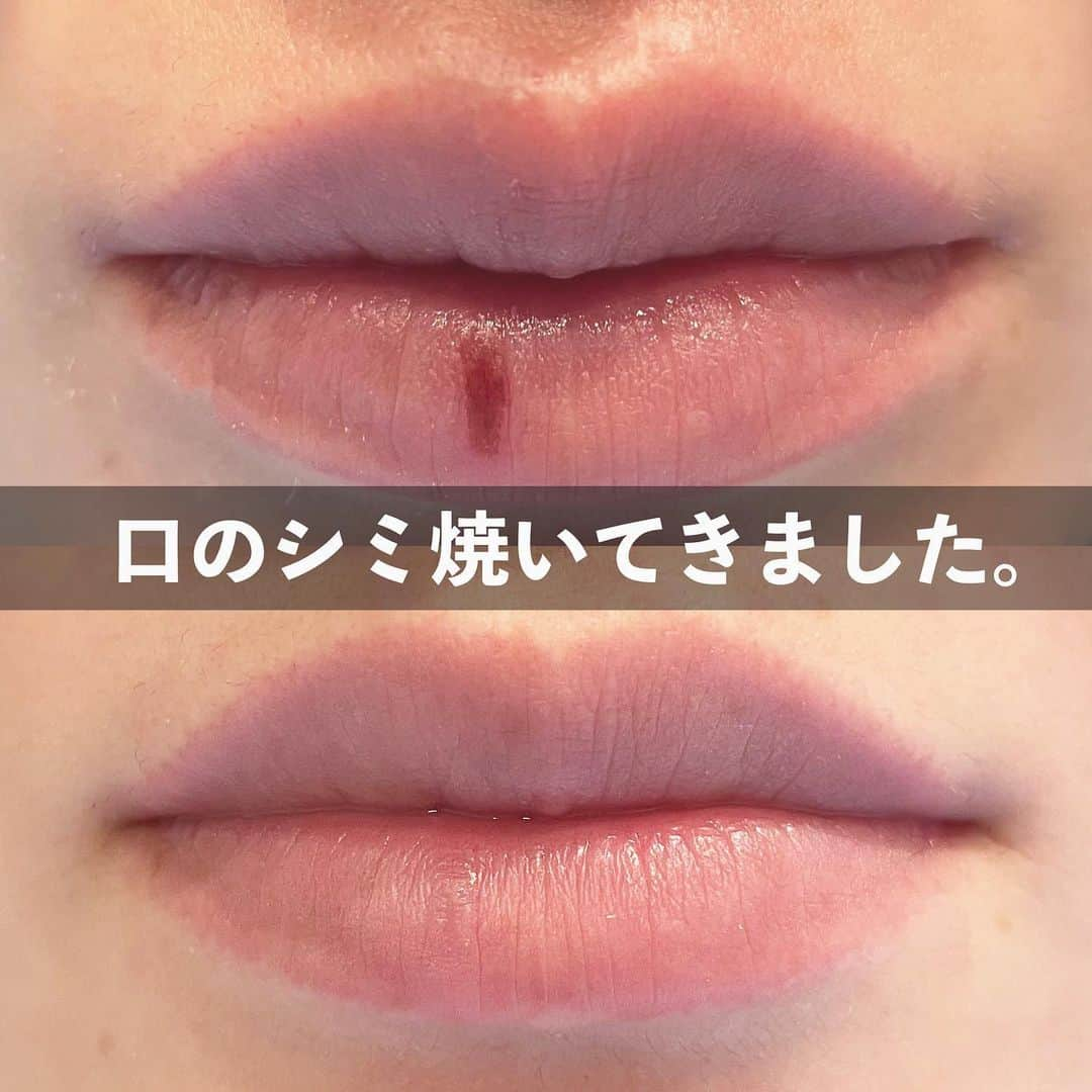 Arisaさんのインスタグラム写真 - (ArisaInstagram)「唇のシミレーザー💋💋 ずっと気になってた唇のシミ。 年々濃くなり、口元のスウォッチの時は加工で消してわからなくしてたけど、素はシミが結構目立ってて気になってたところ。  今回もいつもと同じクリニックの @hadatoha で院長に焼いてもらいました🙏 超痛がりの私のために表面麻酔から、麻酔までしてくれレーザーを😂 なので、実際麻酔しなかった時の痛さがわからなくレポできないw ただ、唇に注射したの💉初めてで😂ちょい痛かった。 なので、レーザー自体は全然痛くなかったですーー🥺 でも、多分冷やすだけでレーザー当ててもよかったかも🤔 注射のほうが痛いと思った☺️どうだろ経験してないからなんとも言えないけどw  経過は画像の通り！ 大体４日目で剥がれそうな感じになって、５日目はぺりんとめくれました！ けど、また2回目も脱皮しそう☺️ それで完全に綺麗になるかも！ これはやってよかったわ😂 こんな簡単に悩みとおさらばできるなんて、、、❤️  口もとのシミ気になる方是非参考にしてみてね❤️  ・ ・ #美容皮膚科#皮膚治療#シミ治療#ピコレーザー#ルビーレーザー#ピコフラクショナル#ルビーフラクショナル#肌と歯のクリニック#千葉美容皮膚科#ホクロ除去#ダウンタイム#ダウンタイム中#ダウンタイム記録#ダウンタイム経過#唇のシミ#唇ケア#口元ケア」5月5日 20時15分 - saarariii