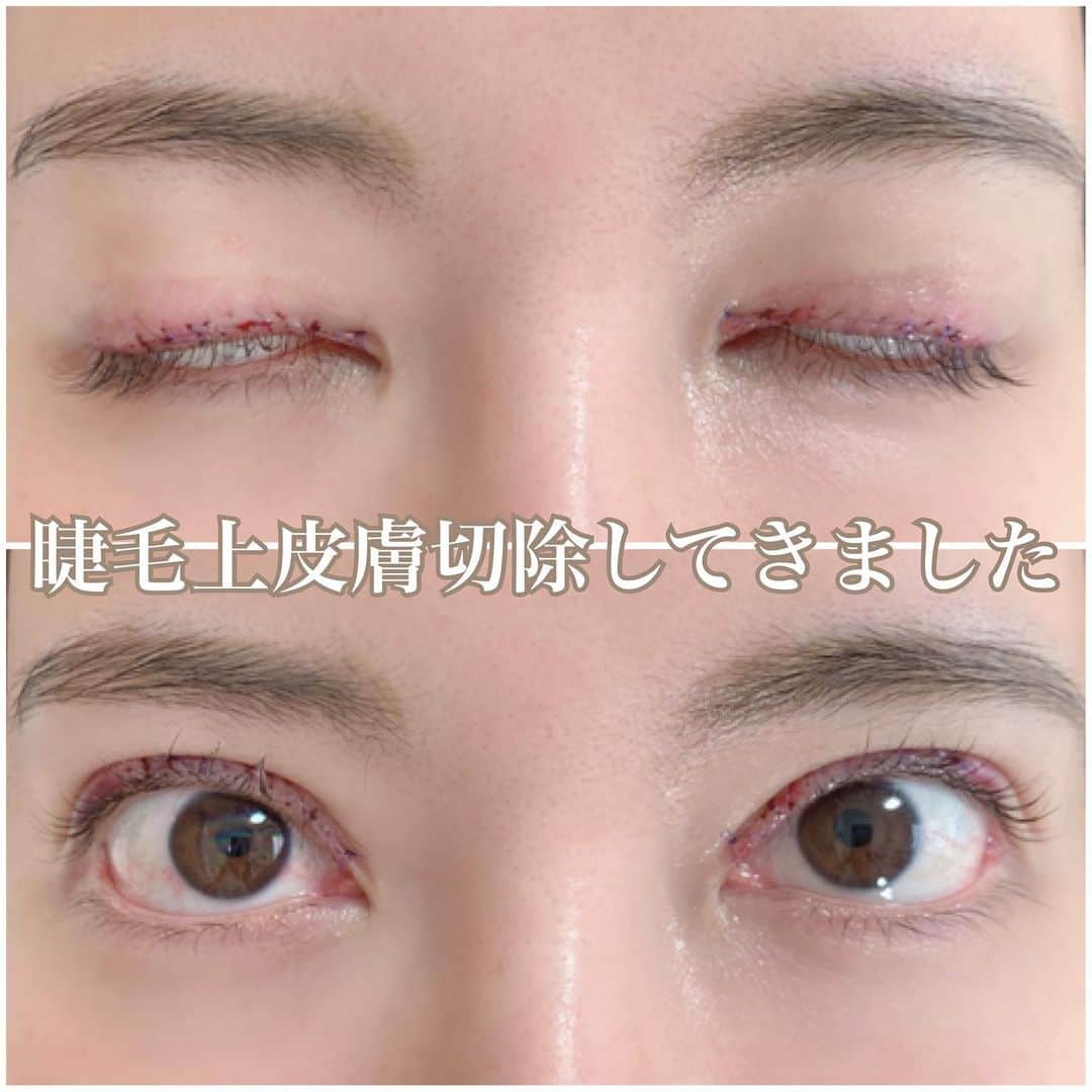 のインスタグラム：「5月8日に山口先生で 睫毛上皮膚切除をしてきました 名前の通り 睫毛上の皮膚を切る施術です☺️💓 . 目頭側から黒目上の皮膚の ハム肉感と幅が気になってたから 皮膚切除してきました👋💕 . 詳しいダウンタイムや詳細は ハイライトにあるから 見逃した方は是非そちらを参考に‼️ . #ダウンタイム#ダウンタイム中#ダウンタイム記録 #ダウンタイム経過 #二重幅修正#睫毛上皮膚切除#二重整形 #整形#整形垢 #美容整形」