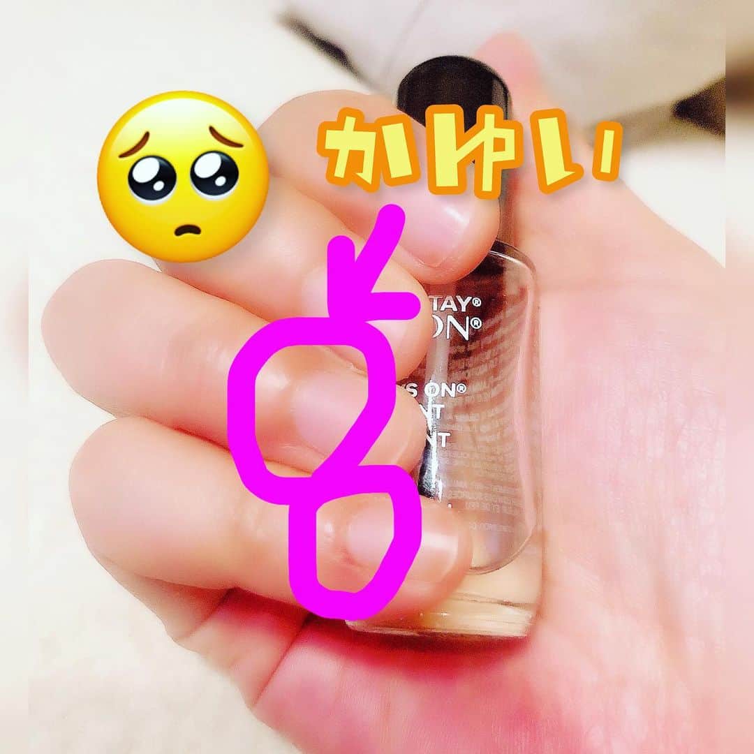 のインスタグラム：「やぱダメだった😂 かゆい！！かゆい！！ 全ての指の丸してある部分が痒い！！ 指の周りも痒い！ えぐいから写真加工したけど皮むけてしまって赤いプツプツできて大変ですよ。 えーん(;ω;) #ネイル #ネイルシール #アレルギー #痒い #もうネイルできない悲しみ」