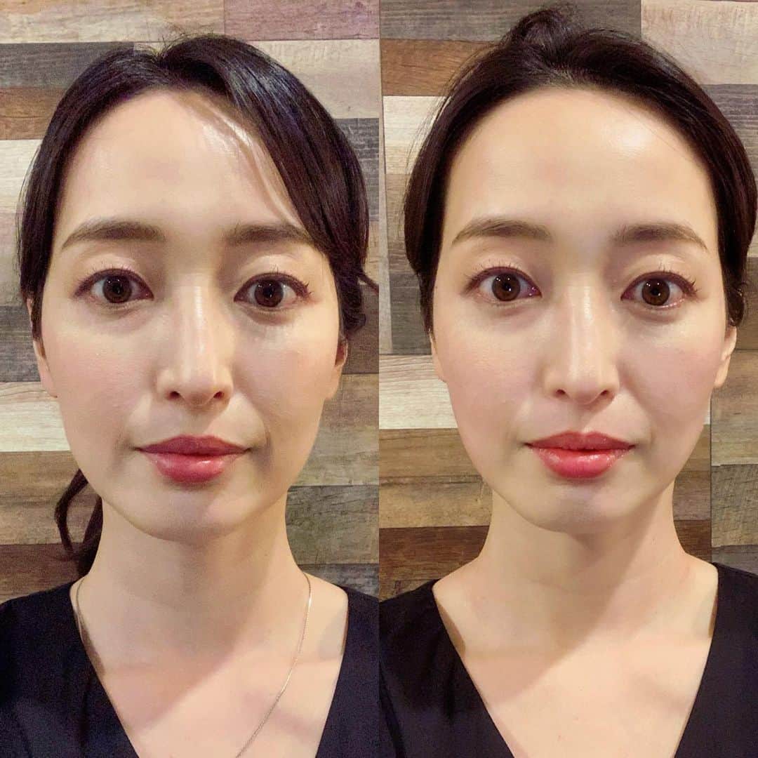 上野なつひさんのインスタグラム写真 - (上野なつひInstagram)「可愛いワンピって悩まなくていいしサラッとオシャレに着れる🐥🌱 お友達の @maako_hinahina のブランドのネックレスが合わせやすくてお気に入り☺️  初の鍼治療に行ってきたよ！☘️ 凄いね、あれ！効果絶大！ エラの筋肉？歯の食いしばり強かったんだけど鍼で柔らかくしてもらったらスッキリしたし食いしばりが緩和された🥺👏 アンド日に日に顔がスッキリして痩せていく！！すごすぎて感動😍肩こりもあるって言ったら頭と肩と首もやってくれて血流良くなって顔がほんのり赤い！ストレートネックだから疲れやすいらしい💦 緩和ケアの先生だから安心だった！  @fuku_total_body_maintenance  ありがとうございました👏」5月19日 18時26分 - natsuhi