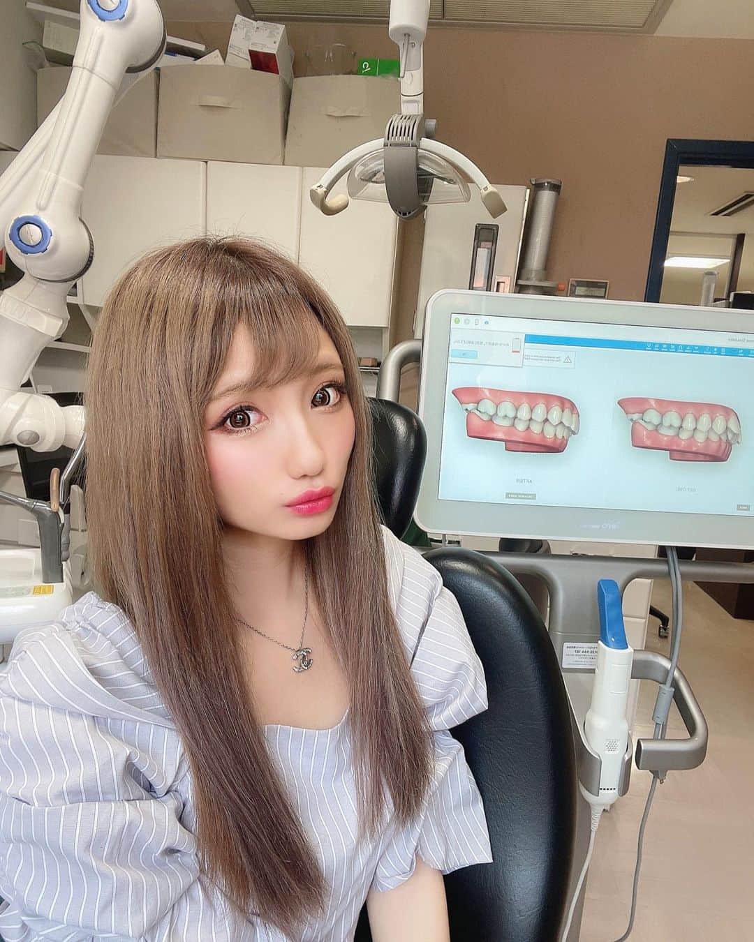 まゆぴちゅーさんのインスタグラム写真 - (まゆぴちゅーInstagram)「歯科矯正シュミレーション体験😳🦷✨✨  新宿にあるカラサワ歯科 @shinjuku_karasawa_dc さん で、デジタルに歯形を採取してもらったの🥺💓  時代って進化してんなぁ〜って思ったけど、 動画のように機械で歯形を読み取ると、 本格的な立体映像で自分の歯の形がでてくるの！✨  それで、もし綺麗に矯正したらどうなるのか！？ っていうBeforeAfterまでだしてくるんです🥺💓  す、すごない！？感動しちゃった🥺🥺✨  わたしの前歯なんか八重歯みたいで可愛いって 言ってくれる人もいれば、綺麗にしたほうが いいのかなーとか私自身も悩んでたから、 綺麗になったこうなるってイメージ体験が できてよかったなぁ☺️🌼♪  来週はね、そのAfterの状態の綺麗な歯並びの 歯形ができてるらしいから、それ見てみるんだ♡ 楽しみ(*˙꒳˙*)‧⁺✧︎*  先生も話しやすくてお悩みとか相談しやすかった♡  コンサルの @t_s_planning の戸田さんも ご丁寧にありがとうございました🥺✨✨ . . . #tandsplanning #歯科矯正 #歯並び #デジタル矯正 #歯形 #歯医者 #矯正歯科 #インビザライン矯正  #美意識向上委員会 #美意識高め #歯科医院」5月22日 17時56分 - mayu_03pichu
