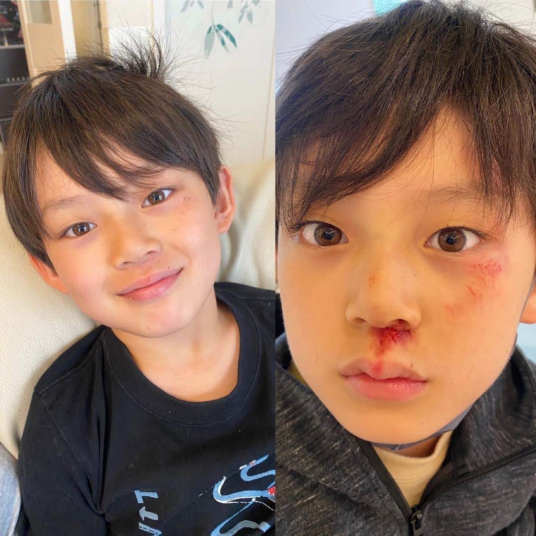 ブラザー4チャンネルのインスタグラム：「【ご報告】﻿ 先週の登校中に顔から転んでしまったあっくん…😣﻿ 昨日の動画から、今後しばらくの間はあっくんのお顔に傷があります💦﻿ ﻿ 昨日の動画で心配のお言葉をたくさん頂きましたが、今現在は傷も治ってきているので、あっくんも元気です✨﻿ ﻿ 4日間でここまで治るのは、やはり若いからでしょうね(笑)﻿ ﻿ ご心配おかけしました！﻿ 視聴者の皆様ありがとうございました😊﻿ ﻿ ﻿ #brother4﻿ #YouTuber﻿ #家族﻿ #ご報告」