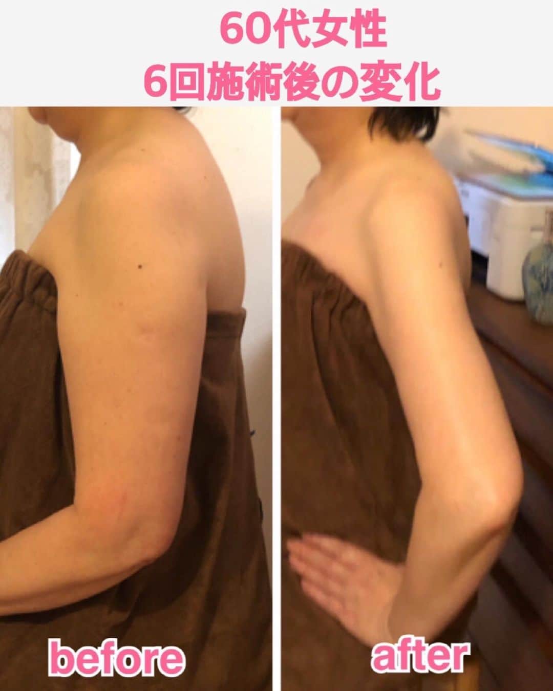 太田莉加さんのインスタグラム写真 - (太田莉加Instagram)「・﻿ ・﻿ 昔からムチムチだるだるの二の腕が﻿ 体型の中で1番コンプレックス。﻿ ﻿ ﻿ 二の腕に特化したエステサロン見つけて﻿ 劇的な二の腕痩せという言葉に 思わず飛びついてしまった😂﻿ @yuikamiki0217 2枚目と3枚目の症例写真見てみて！！﻿ そりゃ飛びつくよね。笑﻿ ﻿ ﻿ 体験会行かせてもらってんけど﻿ もたついてたのが少しスッキリしたのと 肩こりが楽になったよ🥺﻿ コースも検討中！﻿ ﻿ ﻿ #二の腕痩せ#二の腕ダイエット#二の腕コンプレックス#関西ブライダルエステ#神戸ブライダルエステ」6月13日 18時40分 - rikapanda.official