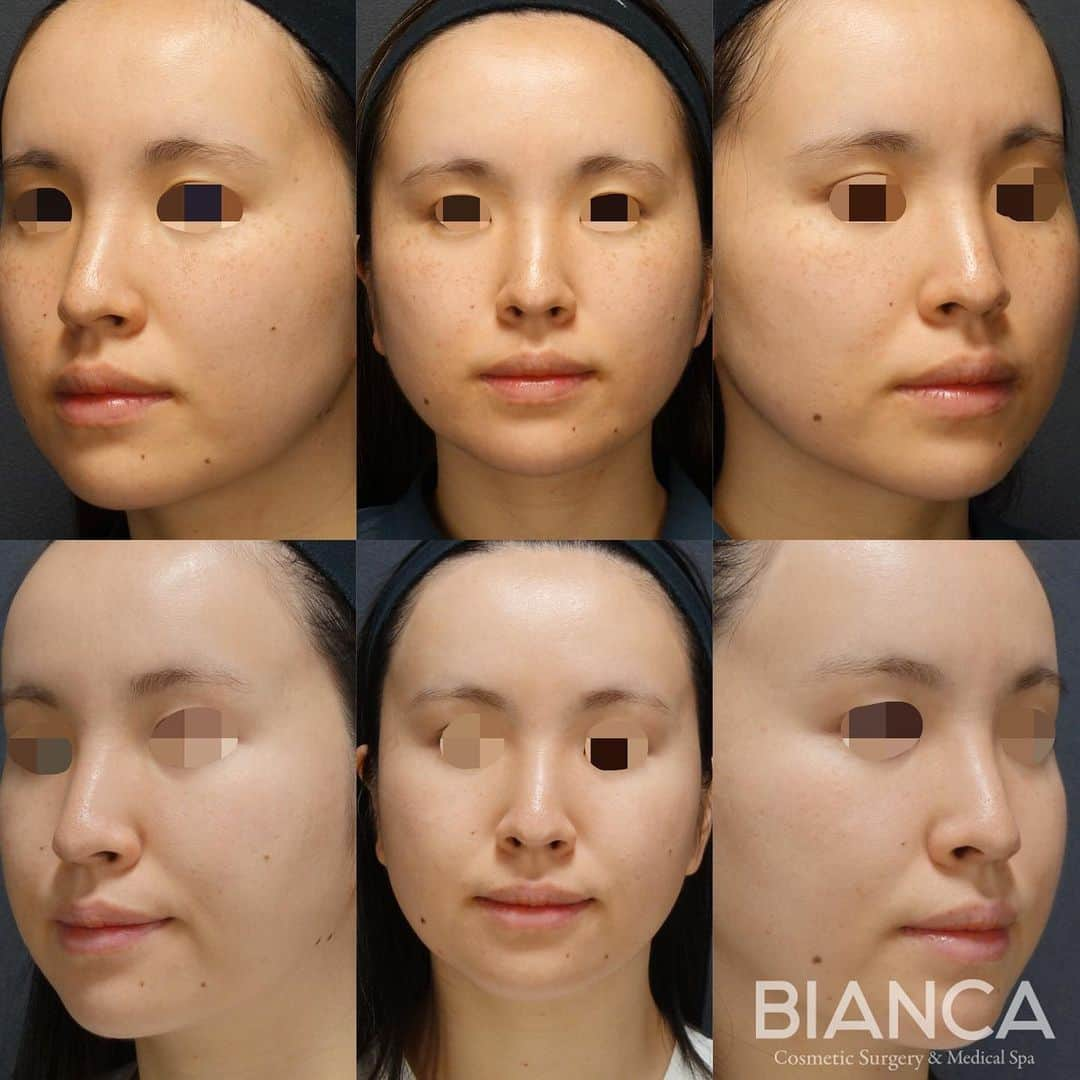 辻沢由有（BIANCA CLNIC 表参道院 院長）さんのインスタグラム写真 - (辻沢由有（BIANCA CLNIC 表参道院 院長）Instagram)「#dryuu肌 ▶︎swipeで文字無し症例&ズーム写真▶︎ 【本気のシミ治療🌟】  シミ治療は決して楽ではありません。 正直、お金も時間もかかるのが事実なんです。 「だからこそ」「せっかくなら」 【本気のシミ治療】をビアンカでしませんか？  上 治療前 下 スポット照射 ＋トーニング20回後  1人で悩んでいる時間はもったいないです❗️😵⭐ 気になる方は是非カウンセリングにお越しください☺️️  💴 ピコスポット 全顔 98,000円 💉麻酔: 表面麻酔 😷DT: シミの黒浮き1週間程度 ⚠️リスク: 色素脱失・色素沈着・水泡形成など 💴ピコトーニング 14,800円/回  🉐モニター大募集中‼️  ⚠️ご予約の際は 『Dr Yuu（辻沢）のインスタ見た』の一言をお願いします👩‍⚕️✨  📍BIANCA CLINIC  ✔︎表参道院 03-6433-5994 東京都港区南青山5-11-10  南青山511ビル 2F ✔︎銀座院 03-6263-2690  東京都中央区銀座1-5-6 銀座レンガ通り福神ビル 4F 診療時間 10:00～19:00 年中無休（年末年始を除く）  #plasticsurgery #cosmeticsurgery  #美容外科 #美容皮膚科 #美容整形 #プチ整形 #美肌 #美魔女 #美容 #アンチエイジング  #picosure #ピコシュア #ピコトーニング #ピコフラクショナル #ビアンカクリニック #dryuu #シミ取り #そばかす #シミ治療 #dryuu美容 #ソバカス #スキンケア #美白 #biancaclinic #ビアンカクリニック #レーザートーニング #モニター募集 #モニター募集中 #followｍe」6月19日 15時25分 - i_am_yuu__