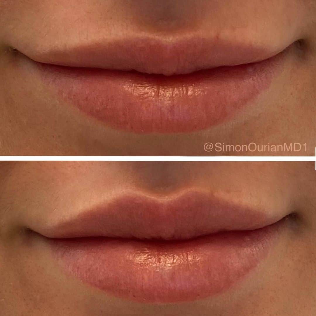 Nicky Gileさんのインスタグラム写真 - (Nicky GileInstagram)「summer flinggg 💘🦋 💋 I’ve been getting my lips done for the past few years by the one and only @simonourianmd1 💛 he’s the best at what he does and I’m always so happy with my results! swipe to see + check out his page for more work ✨」6月26日 9時51分 - nickygile