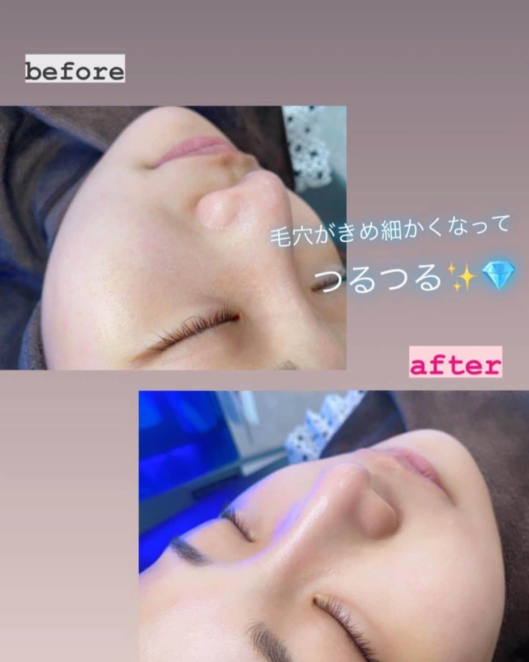 嬉野ゆみさんのインスタグラム写真 - (嬉野ゆみInstagram)「* * こんばんは〜♫今日は金曜日🕊 皆んないつも沢山のコメントとメッセージありがとうございます💕 今日はまたまた美容投稿😉 * * ストーリーにも載せた、肌ケアについて。 この間ハイドラフェイシャルを受けてきました💆‍♀️ * 知っている方も多いかも？✨ハイドラフェイシャルは水の力で毛穴を洗ってくれる施術♫ * 水だけど吸引されるので優しい力ではないですが、赤くなったり荒れたりは無かったです。アフターの写真を見ると、すっぴんツヤツヤになったかな!?(無加工です🙇‍♀️) * 私は敏感肌で、ダーマペンやピーリングは刺激が強くて合わなかったので何もしていませんでした🥺 * * 夏は汗をかくことが多い分、毛穴トラブルが起きやすいそうで、 * 肌がベタつくことで過剰な皮脂が毛穴に溜まって黒ずんだり、触ったときにザラザラした感触になることも💦 * * 個人的にお肌が荒れない対策としては、できるだけお肌に触らない、スマホは毎日除菌する、枕カバー洗う、マスクは使い捨て、日焼け止めをお家にいても塗るようにしてます💕マスクしてても日焼けはしてしまいます😭 * * * 美容医療クリニックの予約サイト、トリビューはクリニックの比較ができたりオンラインカウンセリングもあるサービスです👩‍💻 * * 今だと2000円分のポイントがもらえるクーポンがあります💁‍♀️ クーポンコードは、『うれしの』です☺️ * * トリビューのお得なクーポンについては、インスタのハイライトにも載せるので、そちらからもチェックしてみて下さい♫ * * * * 最近は、インスタで自分磨きがテーマだったりします✨ 内面も外見も努力して憧れられる存在になりたい🤍2年前からインスタを始めて続けてきて、実りある嬉しい報告もできそうです🥰 * * 今週もお疲れ様でした💋みんなにぱちぱち✨👏身体に気をつけてお過ごし下さい✨🥰 * * * * #肌荒れ対策 #毛穴ケア #すっぴん美肌 #美容医療 #肌ケア #ハイドラ#ハイドラフェイシャル  #PR」7月9日 19時36分 - ureshino_chan