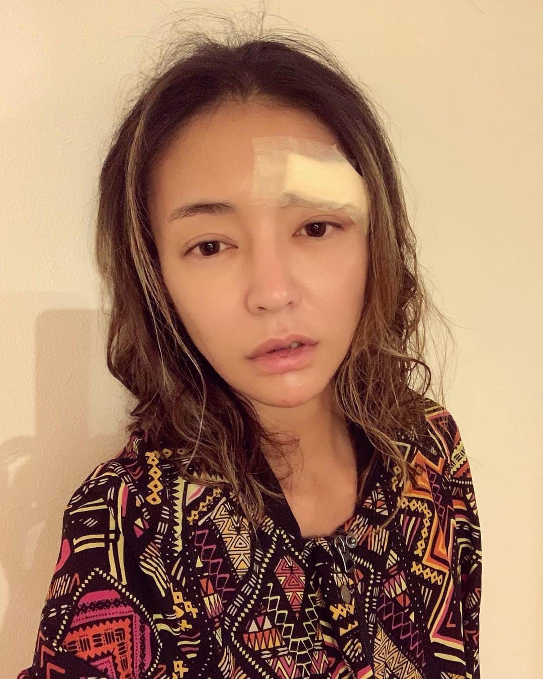 内藤陽子さんのインスタグラム写真 - (内藤陽子Instagram)「ワオ！1ヶ月振りの更新になっちゃってた 体調崩しててね。しかも夜シャワー浴びたら、自分のシャンプーですってんころりん💦 どんだけ間抜けなんだよって言う… さっき救急行って眉下と目尻まで7針縫ってきた。パックリ… 麻酔が切れてきて痛い。。とか言ってられないよね。  #お風呂  #危険 #本当」7月16日 4時42分 - dadaflora