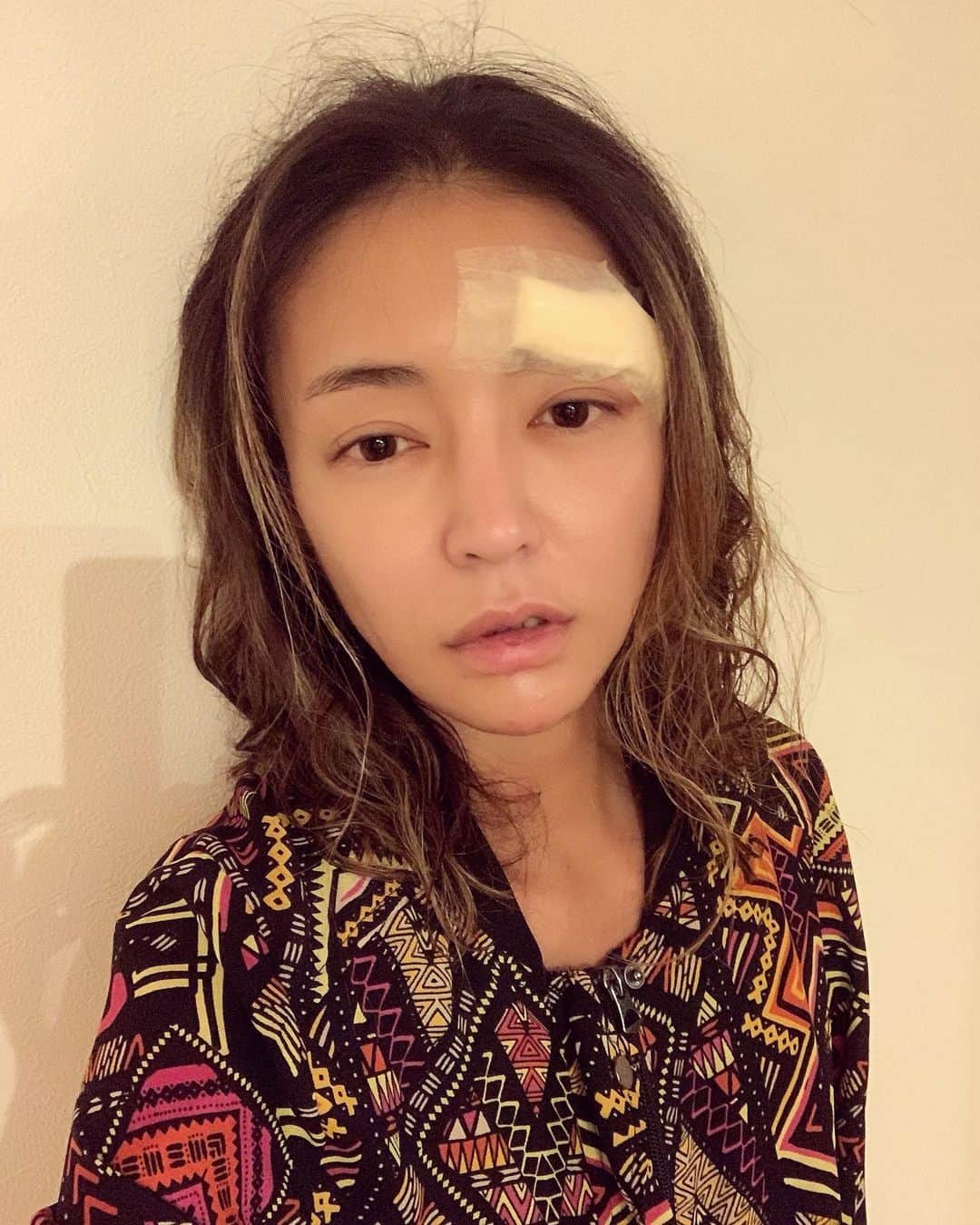 内藤陽子のインスタグラム：「ワオ！1ヶ月振りの更新になっちゃってた 体調崩しててね。しかも夜シャワー浴びたら、自分のシャンプーですってんころりん💦 どんだけ間抜けなんだよって言う… さっき救急行って眉下と目尻まで7針縫ってきた。パックリ… 麻酔が切れてきて痛い。。とか言ってられないよね。  #お風呂  #危険 #本当」