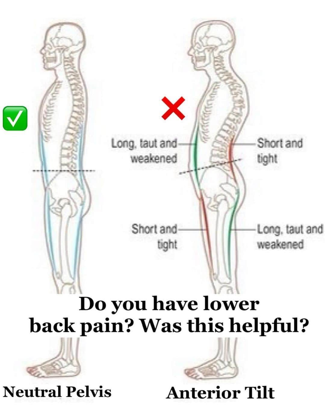 1.9m Fitness Inspirationさんのインスタグラム写真 - (1.9m Fitness InspirationInstagram)「💕💪 Your back and your psoas (hip flexors) are all connected!! Do you have lower back pain? Leave a comment below if this was helpful? What areas of your body have aches and pains that need addressed? . -Hold the stretch for 30-45 seconds -For strength moves shoot for 10-12 reps . Often times a weak core creates tight hip flexors. Having tight hip flexors shortens them which pulls the hips forward and then creates an anterior tilt of the hips. As the hips tilt the back is thrown out of line with a curve in the lower back and BAM ... you have back pain! . Simply put: weak core links to tight hip flexors which cause hips to tilt forward = low back pain. . So here are a few ways to strengthen and stretch our hip flexors, core and lower back so our posture and core support can improve to reduce back pain! by @deliciouslyfitnhealthy #backpain」8月23日 0時44分 - fitgirlsworldwide