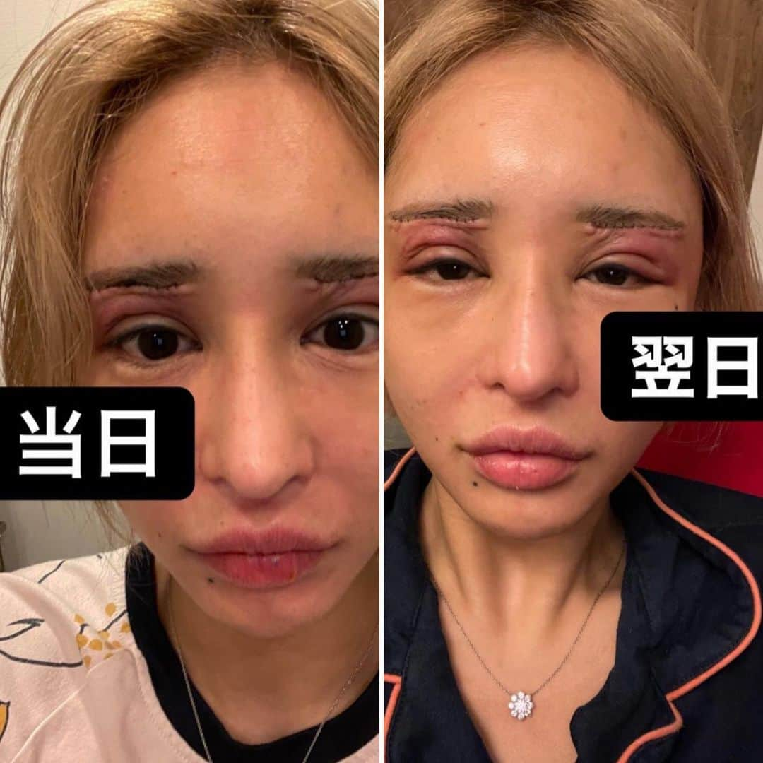 桜井野の花のインスタグラム：「ダウンタイムも生理と一緒で、２日目ってのが一番辛い。 ・ 気持ち、髪がハゲ散らかってる…気がする。 ・ #美容整形#整形#眉下切開リフト#上眼瞼リフト#ボトックス#Botox#涙袋#歌舞伎町#キャバクラ#キャバ嬢#R#アール#桜井野の花#ダウンタイム中」