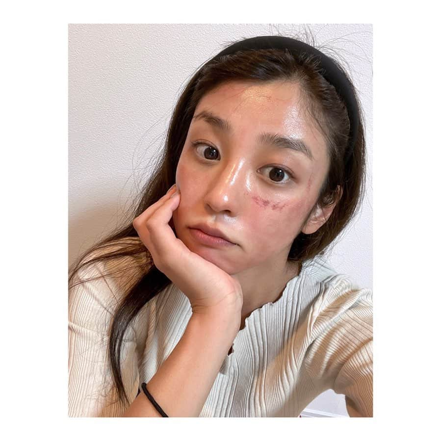 岡副麻希さんのインスタグラム写真 - (岡副麻希Instagram)「. 先日受けたヴェルベットスキン🪞 （ぼさぼさで失礼します笑） ⁡ ダウンタイムはそのときの体調にもよるとはこのこと！ 今まで何回か受けてきて翌日には赤みも引いてたのですが，今回はびっくり！強めに反応しました🌞疲れてたの？🥺と自問自答（笑） ⁡ ただ，今までメイクさんが嘆くくらいに 手強かった目の下のクマが薄くなったり 蓄積した紫外線の色素沈着も薄くなるし 何よりツヤツヤになるからやはり定期的に受けたい＾＾🤍 ⁡ カウンセリングで比較的ダウンタイムが少ないらしい ピコトーニングもおすすめしてもらったので 次はレーザーデビューもありかもなんて検討中🤔 ⁡  @dr.sato_reiji @original_beauty_clinic_ginza  お肌のケアだけではなく花粉が辛いときは 色々な点滴を提案してくださったりと お世話になってます🥺🌿 ⁡ #スキンケア#肌ケア#花粉症 #ヴェルベットスキン」9月19日 18時27分 - maki_okazoe_official