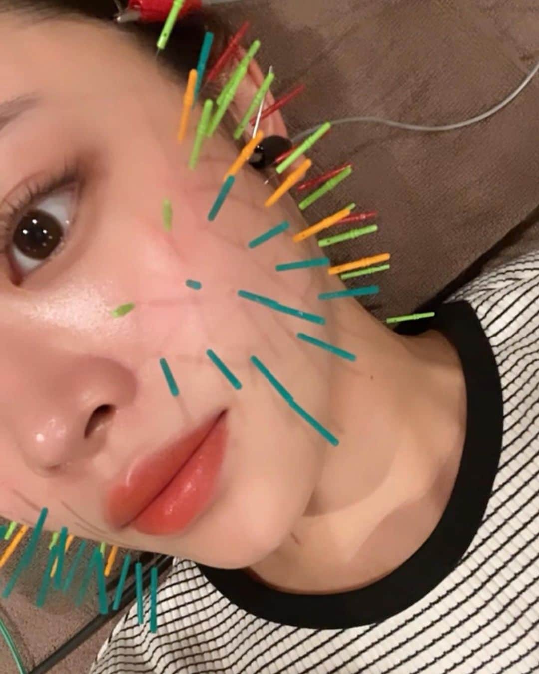 高木由梨奈のインスタグラム：「この間、久々の鍼行ってきました🦔 痛々しい見た目だけどやってる最中は全く痛くないよー！ 鍼を刺す時は少しだけチクっとします😂 終わった後のむくみの取れ具合が毎回感動しすぎて、撮影の直前にお世話になることが多いです😉 ちなみに @kadomori_kogao でやってもらっています💖  #鍼 #美容鍼 #むくみ解消」