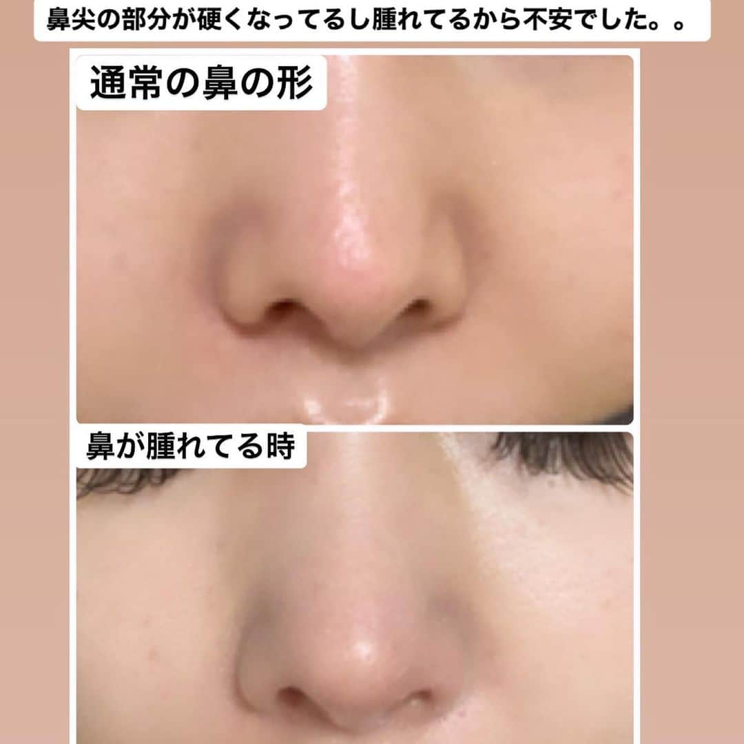 吉川ちえさんのインスタグラム写真 - (吉川ちえInstagram)「【鼻の整形後の恐怖👃】 . 私は鼻の整形を5回程やってます✨ 今はすごく鼻の整形して満足していますが いつも頭のどこかにあるのは "鼻の感染"という恐怖😱💦 . 鼻の整形5回もしてるから元々 鼻の血流はよくありません。 皮膚もかなり薄くなってます💦 . つい数日前に鼻が突然腫れて 鼻の穴の形が変わりました‼️🥲 その時私は感染を疑い 凄い怖い思いをしたので 良かったら画像横にスワイプして見て欲しいです😂🙏✨ . #鼻の整形 #鼻整形 #鼻中隔延長 #鼻尖形成 #整形 #整形後トラブル #鼻感染 #美容整形」9月5日 21時24分 - yoshikawachie_16