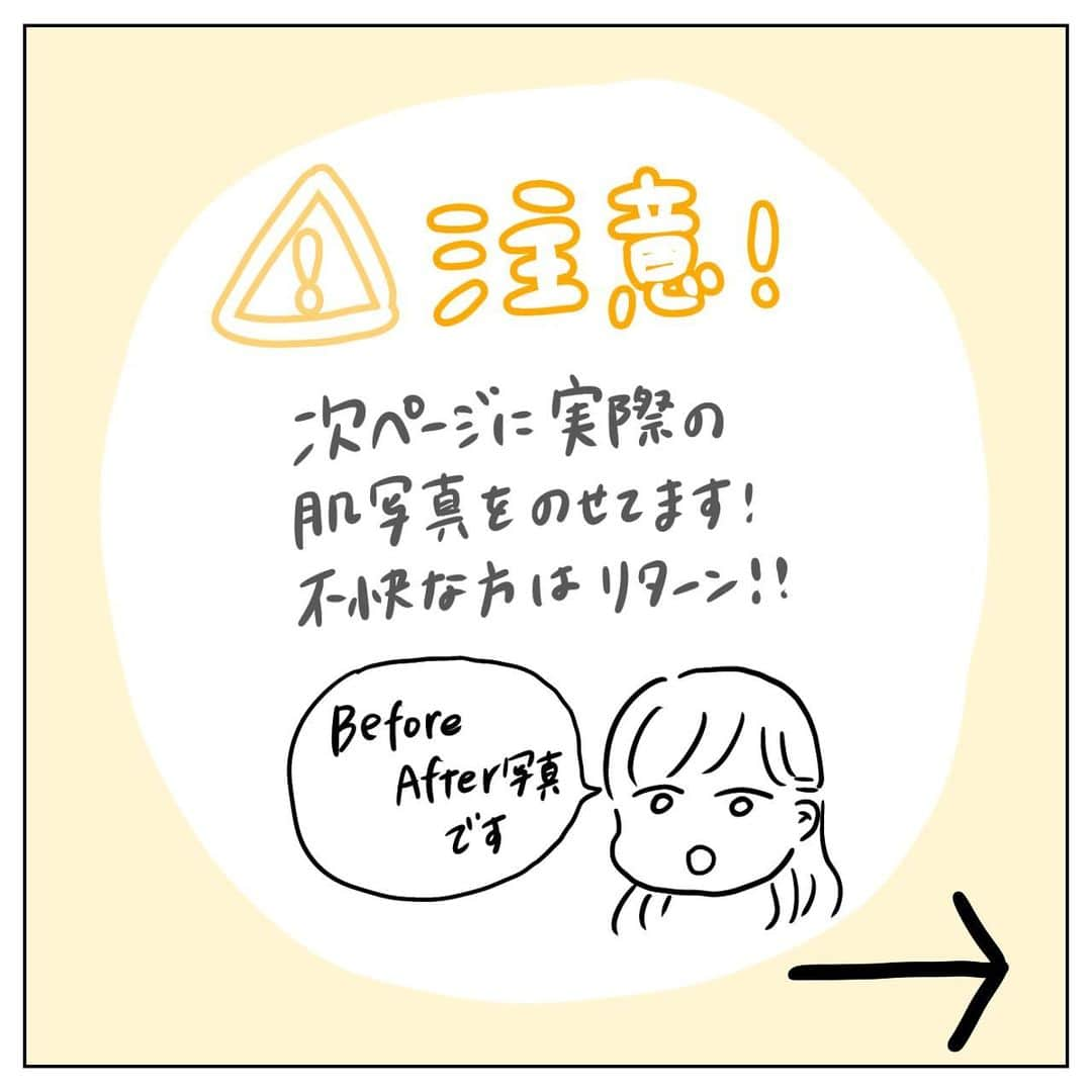 サヤカさんのインスタグラム写真 - (サヤカInstagram)「これにて完結です！！  ⚠️8枚目実際の肌写真があります！ 大人になってからは少し落ち着いていたのですが、2年前になぜか急に酷くなり病みました😅 あまりの酷さにその時撮った写真が残ってたので、比較として載せました。  私はたまたまビオデルマというクレンジング水が合い、今はだいぶ良くなりました。  スキンケア方法は本当に千差万別ですが、きっと今悩んでいらっしゃる方にも、絶対に合うスキンケア方法があるかと思います。 諦めず、そして、今まで頑張ってきた自分を労ってあげてくださいね😭  前回postを見て、ビオデルマを買って下さった方達から「なぜか肌調子がいい！」と複数DMを頂いてます😭 もしここまでエッセイを読んできて、私と同じような肌質の方がいるのなら、試す価値はあるかと思います！ どうかどうか、皆の肌悩みがまとめて解決されますように！！！本当に！  それとビオデルマの使い方は色々あるかと思いますので、ご自身に合った使い方を見つけていただければと思います！ 例えば私は朝、水道水だけで洗顔するよりこれで拭き取る方が調子が良いのでそうしてましたが、気になるようならクレンジングとしてのみ or その後流してもいいです〜！  私はいつも楽天市場で買ってます🐰ハイライトの楽天ルームから飛べます！  こうやって商品名を出すとステマ？と思われてしまうかと思いますが、本当に本当にただのリピーターなだけで、ビオデルマさんとは何の関係もございません、、！🙇🏻‍♀️ 途中商品名を伏せようか迷ったのですが、ここまで描いといてそれはさすがに無いなと思ったのと、私が読者側だったら何が何でも知りたいだろうなと思ったので、紹介させて頂きました。  .  #イラストエッセイ #コミックエッセイ #実体験漫画 #実録漫画 #4コマ漫画 #インスタエッセイ #インスタ漫画 #インスタコミック #肌荒れ #肌荒れ改善 #ニキビケア #ニキビ #ニキビ肌 #コンプレックス #醜形恐怖症 #肌質改善 #スキンケア #肌診断 #すっぴん #クレンジング #ビオデルマ #ビオデルマクレンジングウォーター #ビフォーアフター写真 #オルビスユー #オルビス #ビオデルマサンシビオ #ニキビ治療 #肌荒れケア #ニキビ跡」9月6日 19時54分 - sawayakasayaya