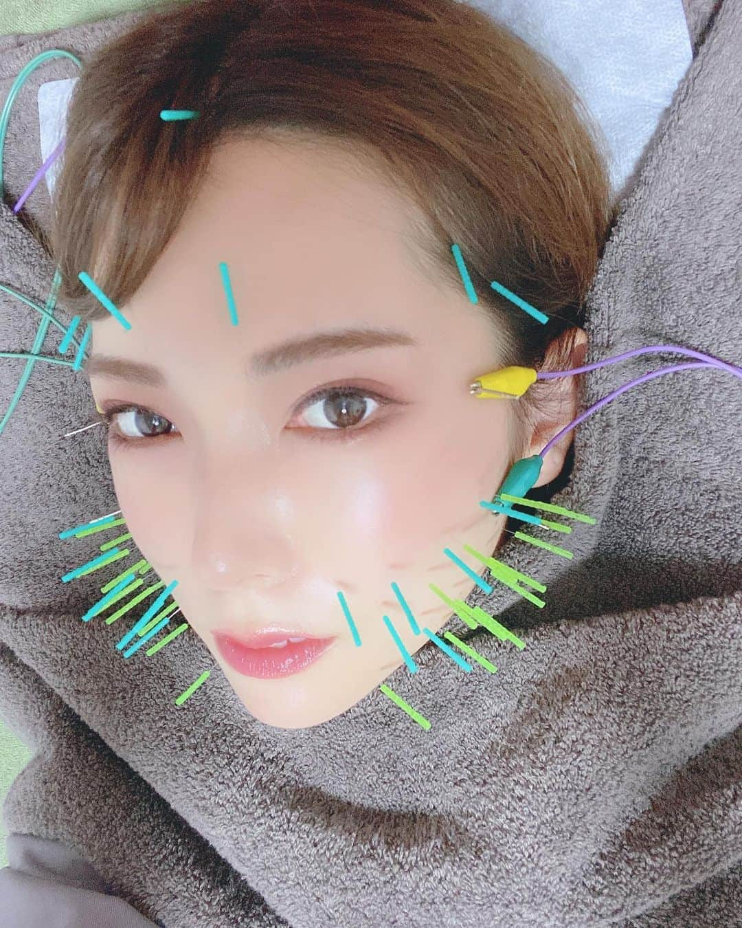 波多野結衣さんのインスタグラム写真 - (波多野結衣Instagram)「美容鍼いってきました！😊 あいちんに紹介してもらって杉崎先生(@sugizakikenya )に美容鍼打ってもらいました！！  顔と初めての背中🥺  普段使わない表情筋とかが刺激されて、やる前やった後に顔触ったんですがだいぶ位置が変わってました！  背中も首と肩とかに打ってもらったんですが、ズーンって感覚で気持ちよかったです！😊  鍼も暫く通うと効果出るみたいなので通います🥺  私の万年肩こりよ治れ〜〜🥲  #金髪院長 #形状記憶美容鍼 #きゅきゅっと美容鍼 #美容鍼  #美容鍼灸  #鍼灸  #鍼 #小顔  #リフトアップ  #むくみ  #形状記憶 #たるみ改善  #ハリ  #弾力 #眼精疲労  #波多野結衣」9月26日 10時25分 - hatachan524