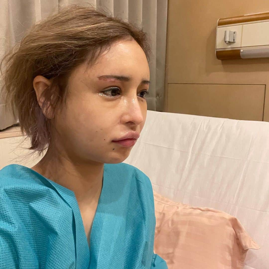桜井野の花のインスタグラム：「念願のプレート除去の手術を受けてきました。  今回は整形ではなく骨切りの手術で固定していたボルトを抜く手術です。  これでやっとMRIで脳の検査が受けられます🥺 びまん性大脳萎縮の進行が止まればいいけど。  ついでに顔面麻痺も改善も🥲🥲🥲  てか、こんなイカツイプレートとボルトが20本も顔に入ってたなんて…恐怖www  術後すぐはそんなに腫れなかった😇😇😇  #整形#美容整形#骨切り#ssro#ルフォー#後遺症#顔面麻痺#プレート除去#手術当日#術後１日目#ノーマルカメラ でお届け」