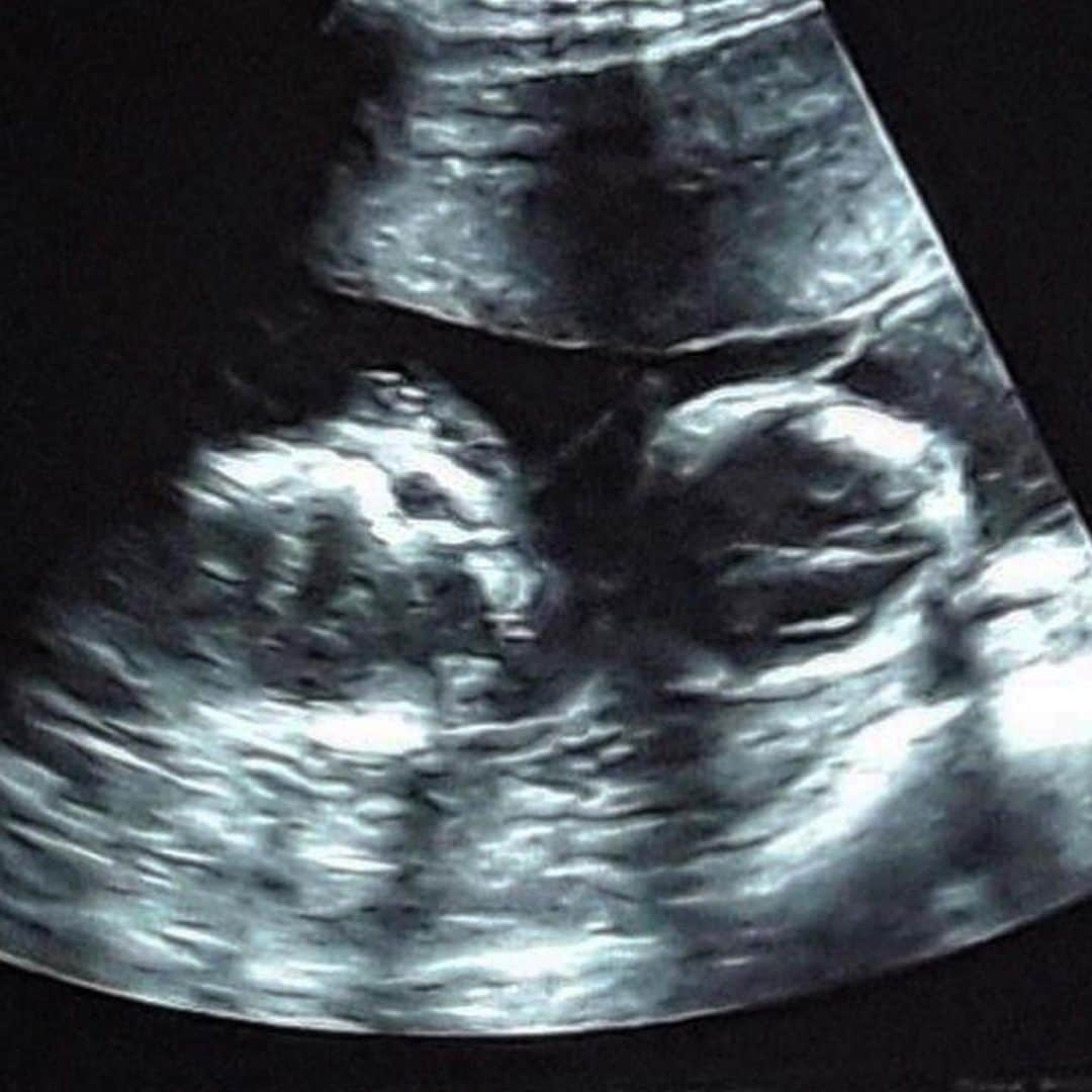 Silvia Carusoさんのインスタグラム写真 - (Silvia CarusoInstagram)「Beyond happy to announce we are having dizygotic twins (different twins )!! One boy and one girl ❤️❤️❤️❤️ I’m a little pink whale 🐳」11月27日 23時52分 - silvialicius