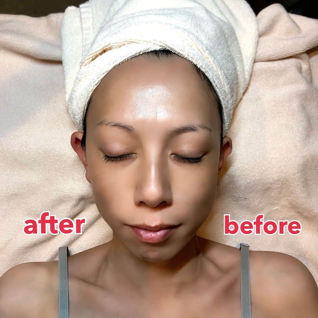 大原かおりさんのインスタグラム写真 - (大原かおりInstagram)「久しぶりのエステ👱‍♀️💖 ここ最近の乾燥で、肌荒れとたるみが気になりすぎて。。 麻布十番の『annfism』で、お肌改善の人気メニューエステをしてもらってきたよ〜👱‍♀️💕 @annfism_facial  ☺︎ ComfortDualというラジオ波マシンと、 香りが良すぎて癒されるChristinaのお化粧品で ハンドエステ＆フェイスパックもしてもらったら。。 カサカサだったお肌も帰りにはしっとりモチモチに😍❤️ ☺︎ プルメリアのような優しい香りと、 すごく優しいスタッフさんの施術で心もお肌も 癒されましたっ☺️🌸 ☺︎ ２枚目の写真はComfortDualのラジオ波マシンで まずは顔半分だけやってもらったら。。 片方だけ引き上がっていた写真♡♡♡ 即効性がありすぎて自分でもビックリ！！ (眉毛が薄くて恥ずかしい🙈💭w)  強力パワーのラジオ波を、スポットで皮膚深部に照射して皮膚組織内に直接作用されるのでたるみ改善や引き締め、小顔効果があるそうです😻✨ 『annfism』のエステコース、速攻性抜群なので カサカサかんそやたるみでお悩みの方は 本気でオススメです❣️❣️ ☺︎ 💐annfism💐 〒106-0045 東京都港区麻布十番1-5-19 ラトリエ･メモワールビル4Ｆ 03-6804-2356 ⑅*⸌◡̈⸍*⑅ #annfism #アンフィズム #麻布十番 #トータルビューティーサロン #美容 #ComfortDual #コンフォートデュアル #Christina #美容 #女子力アップ #二重あご #目元口元のたるみ #毛穴のたるみ #小じわ #シミ #ほうれい線 #ニキビ改善 #赤ちゃん肌 #麻布十番エステ #女子力向上 #女子力向上委員会」11月28日 13時09分 - oharagaori_otty