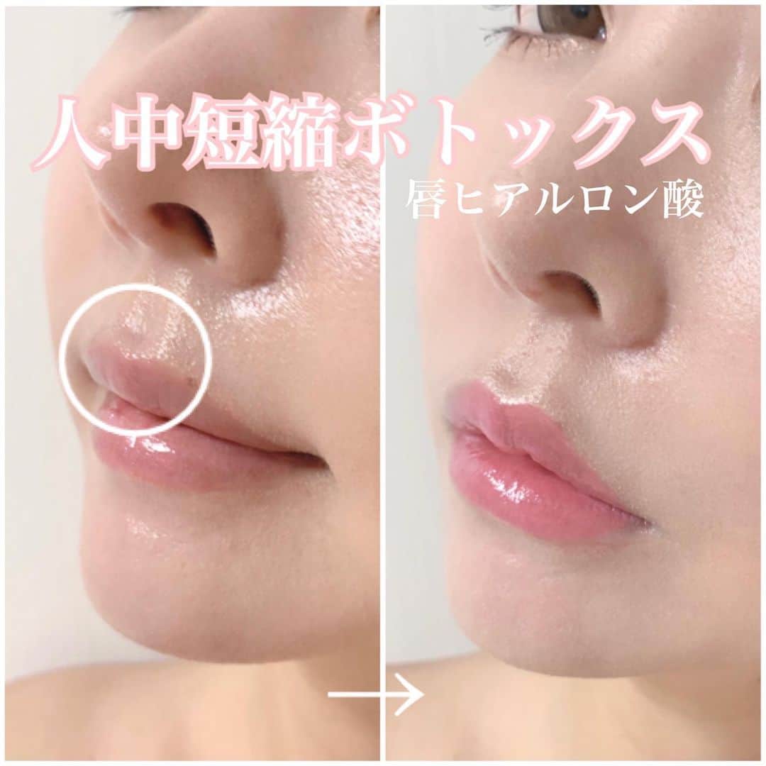 のインスタグラム：「先月、人中短縮ボトックスと 唇にヒアルロン酸注入したよ🥺💓   年々、年齢を重ねる度に 唇が薄くなってきてたから 思い切ってやってみた🤣💓  やっぱりレナ先生の注入は 自然だから ナチュラルに仕上がる✌️  カウセをして一人一人に合う量を注入してくれるから 綺麗に仕上がりました🥺💓  (@drrena.a ) (@rejuva_by_drrena )  唇ヒアルロン酸ってかなり 顔のイメージ変わるから レナ先生にやってもらって良かったです😭💓  ハイライトにダウンタイムの 様子を載せてるから見てね！ (私の場合ダウンタイムほぼ無かったです)  #唇ヒアルロン酸#ヒアルロン酸注入#人中短縮#人中短縮ボトックス#整形#プチ整形#ボトックス注射」