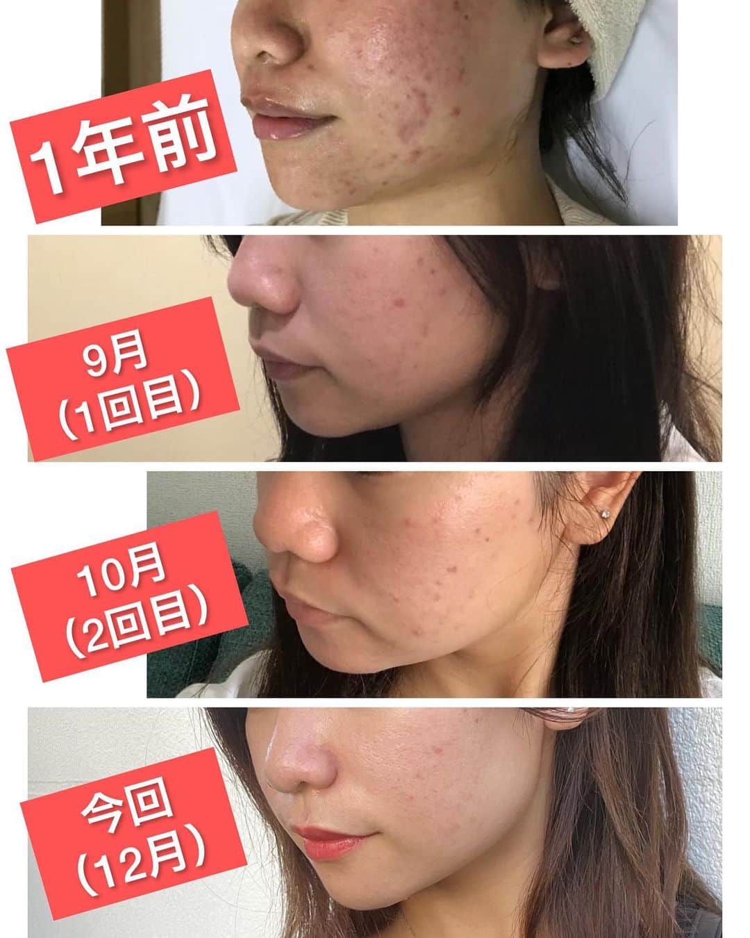 Tazumiさんのインスタグラム写真 - (TazumiInstagram)「先日、5回目の美容皮膚治療が終わりましたー！🥳✨  9月に #ダーマペン と #次世代hifu の2種の治療を開始🤔✨  1回目でも既に効果を実感していたのですが、コース制の5回でどうなるのか…🤔✨  2枚目がその結果です😎  元々、乾燥肌&敏感肌&皮膚炎になりやすい肌質&内臓が弱く皮膚に出やすい体質で人並みの生活が出来ない身体で、 人に合わせて食事やお出かけが頻繁に出来ないから、 自己管理で何とか今年の美容を繋いでいたのですが、  ジョウクリニックで治療を受けて、周りの久々に会う人達から「肌綺麗になってね⁉︎」って言われてお化粧も楽しくて、  切羽詰まって化粧品紹介されては手を出して治らないまた肌荒れ… って毎月悩んでいた半年前に比べて医療に助け求めれば良いんだなって実感しました😂✨  次世代HIFUも実際どーなんの？🤔 って言う半顔検証も今回半分ずつで施術してもらったので是非参考に😚  @joe_clinic  @joe.clinic.naha   #joeclinic #beauty #hifu #okinawa #ジョウクリニック #ジョウクリニック那覇院 #美容 #美容整形 #美容実験 #肌荒れ改善 #シワ改善 #美白ケア #沖縄モデル #沖縄生活」12月9日 22時53分 - tazumi_0225