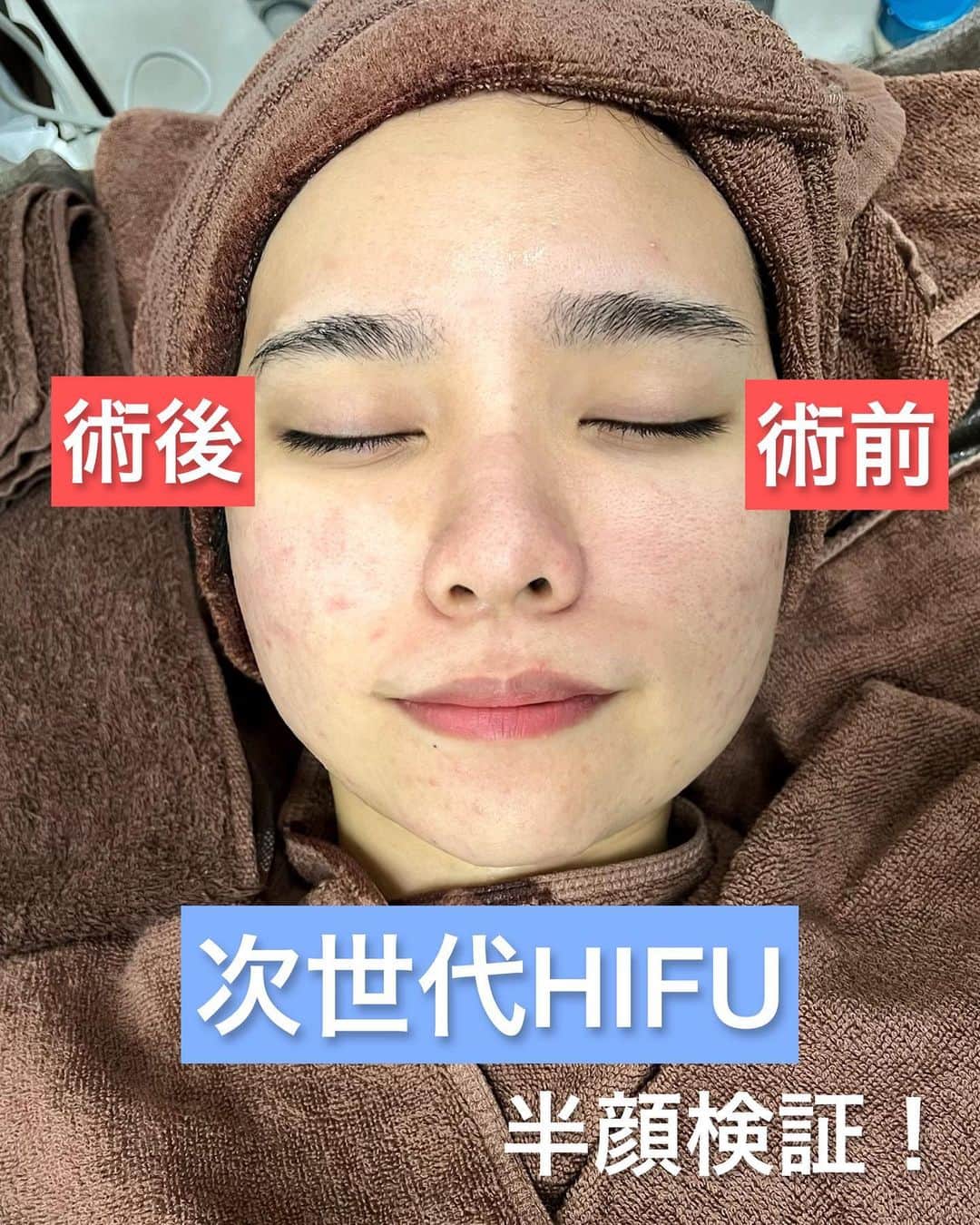 Tazumiさんのインスタグラム写真 - (TazumiInstagram)「先日、5回目の美容皮膚治療が終わりましたー！🥳✨  9月に #ダーマペン と #次世代hifu の2種の治療を開始🤔✨  1回目でも既に効果を実感していたのですが、コース制の5回でどうなるのか…🤔✨  2枚目がその結果です😎  元々、乾燥肌&敏感肌&皮膚炎になりやすい肌質&内臓が弱く皮膚に出やすい体質で人並みの生活が出来ない身体で、 人に合わせて食事やお出かけが頻繁に出来ないから、 自己管理で何とか今年の美容を繋いでいたのですが、  ジョウクリニックで治療を受けて、周りの久々に会う人達から「肌綺麗になってね⁉︎」って言われてお化粧も楽しくて、  切羽詰まって化粧品紹介されては手を出して治らないまた肌荒れ… って毎月悩んでいた半年前に比べて医療に助け求めれば良いんだなって実感しました😂✨  次世代HIFUも実際どーなんの？🤔 って言う半顔検証も今回半分ずつで施術してもらったので是非参考に😚  @joe_clinic  @joe.clinic.naha   #joeclinic #beauty #hifu #okinawa #ジョウクリニック #ジョウクリニック那覇院 #美容 #美容整形 #美容実験 #肌荒れ改善 #シワ改善 #美白ケア #沖縄モデル #沖縄生活」12月9日 22時53分 - tazumi_0225