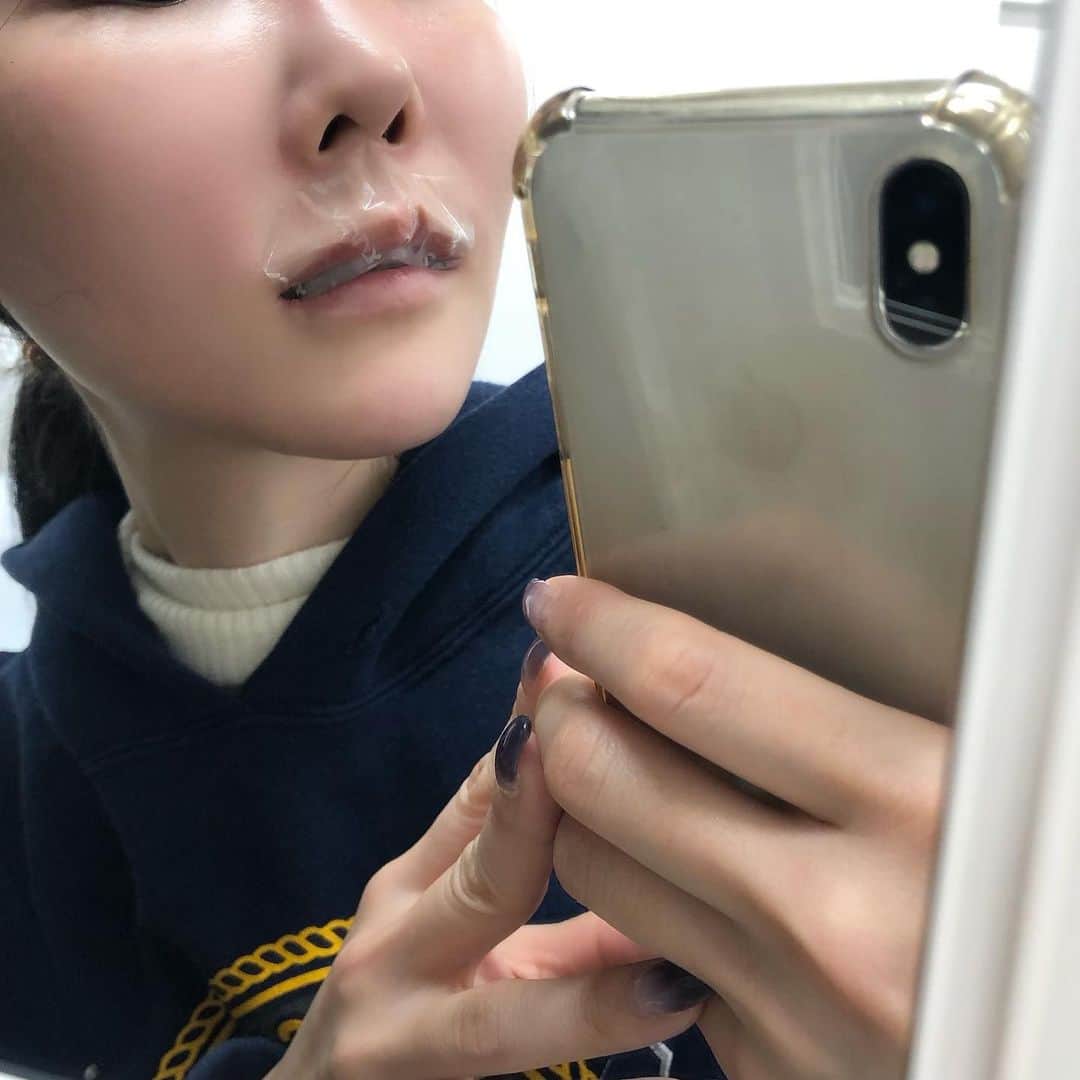 七菜乃のインスタグラム：「これは何かというと、 唇の💋麻酔テープです❣️ 初めて体験した！ この姿なんか可愛いなと😂  私笑うと上の唇がなくなるので、 たまにヒアルロン酸してます🤗  今回は何年ぶりかに、、 ほんのちょっとだけ、、、 下唇は左右差があるので右側だけに、、、 上唇は麻酔したけど 上唇の方が痛かったな😂  本当は人中短縮したい〜  ビフォアの写真撮るの忘れた ばかですね😂  #ヒアルロン酸 #唇のヒアルロン酸 #病院医療 #美容は継続」